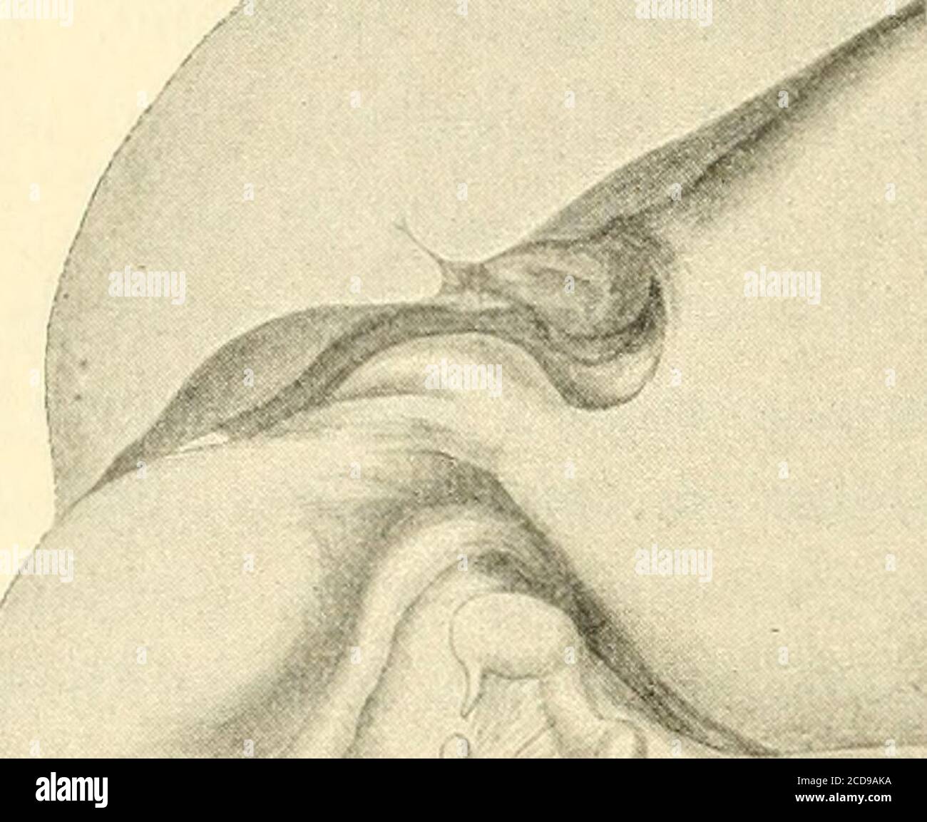 . Anatomiche Hefte . rt). Ein unreifes, männliches, wohlgeLildetes kind; Gewicht 1600 g. Mutter gesund, Ill-P., die bischer gesunde Kinder gehabt bat. DAS genre chapeau trotz Lavement niemals Stuhlgang gehabt. Es Hat nachAngabe die ersten 5 Tage die Bru> t genommen, dann aber nicht mehr. Betrieb einer bürgen, kärnten, Kähnlichen, Kähnlichen, Kähnlichen, Kähnlichen, Kähnlichen, Kähnlichen, Kähnlichen. Im Krankenhaus wurde ein Wasserlavement gegeben, wobi schybalaförmigeMassen von halbdurchsichtiger, glasiger, hell grauweisser Färbung erhalten wurden.am folgenden Tag Banque D'Images
