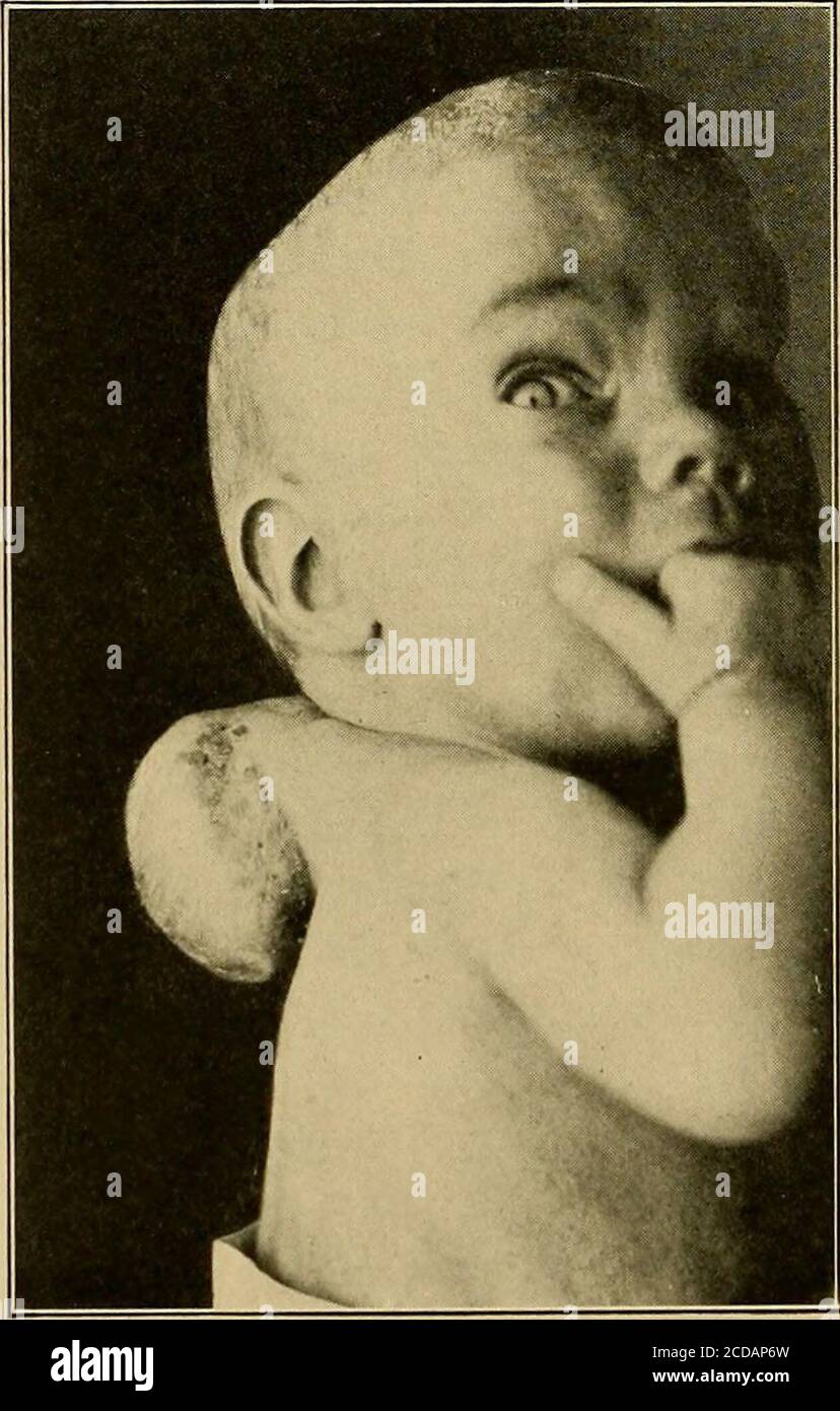 . Diagnostic physique . exososes sont possibles, le buthabituellement se produisent plus tard dans la vie. L'examen histologique décidera. (e) l'épithélie, provenant de la peau du dos, présente les évidences ordinaires de cette forme de cancer. Si) les multiples abcès sous-cutanés dus à des morves {farcybuds) sont plus communs sur les extrémités, mais peuvent être trouvés sur thetrunk aussi. Les nœuds aplatis, ovales, fluctuants avec une légère tendresse sont suggestifs. L'examen bactériologique du contenu du purulenttable le diagnostic. V. Scapula proéminent. Ceci est généralement dû à : (a) courbure latérale de la colonne vertébrale (se Banque D'Images