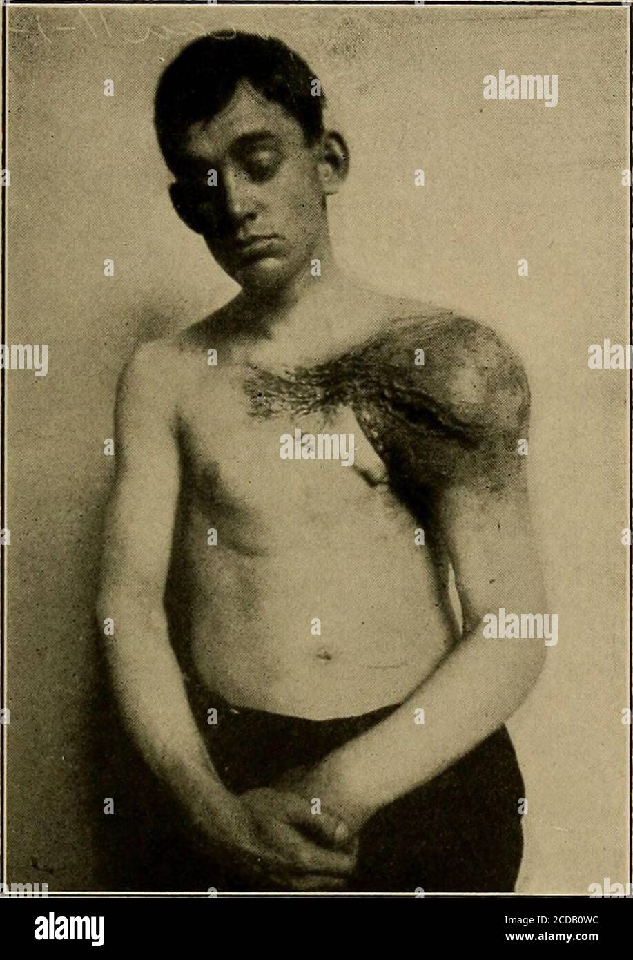 . Diagnostic physique . ower moitié des projets de biceps aiguilléquand le muscle est contracté, regardant comme si les biceps avaient glissé vers le bas de son site normal. Cette apparition soudaine après une souche de la déchiquette des biceps est diagnostique. Les nœuds syphiliques sont aplatis les élévations sur l'os, habituellement de la taille d'un demi-dollar, et se sentent comme le callus après une fracture, projettent seulement d'un côté de l'os. Il y a de la douleur, surtout la nuit, et une tendresse modérée. Une histoire ou autre et plus 1 distingué, comme tout œdème, par le fait qu'une bosselure faite en pressant avec le doigt le fait Banque D'Images