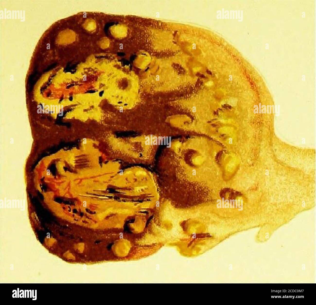 . Un guide pratique pour l'inspection de la viande . FIA. 24.—larynx de la vache (tubercule) ouvert, montrant— U. Élévation de la membrane muqueuse par les nodules tuberculeux subjacents.6 6, h. MaHses de tubercule jaune eximsed par l'ulcération et l'absorption de la muqueuse MembraneeV. Ulcère de bord après l'irruption du tubercule—intensément Hyper-. Figure 25.—le Gland lymphatique (Bronchial) de Cow, laidopen pour montrer le dépôt de Tubercle caséeux et calcareousTubercle à son intérieur—principalement à son lijlum—^avec des masses plus petites. Banque D'Images