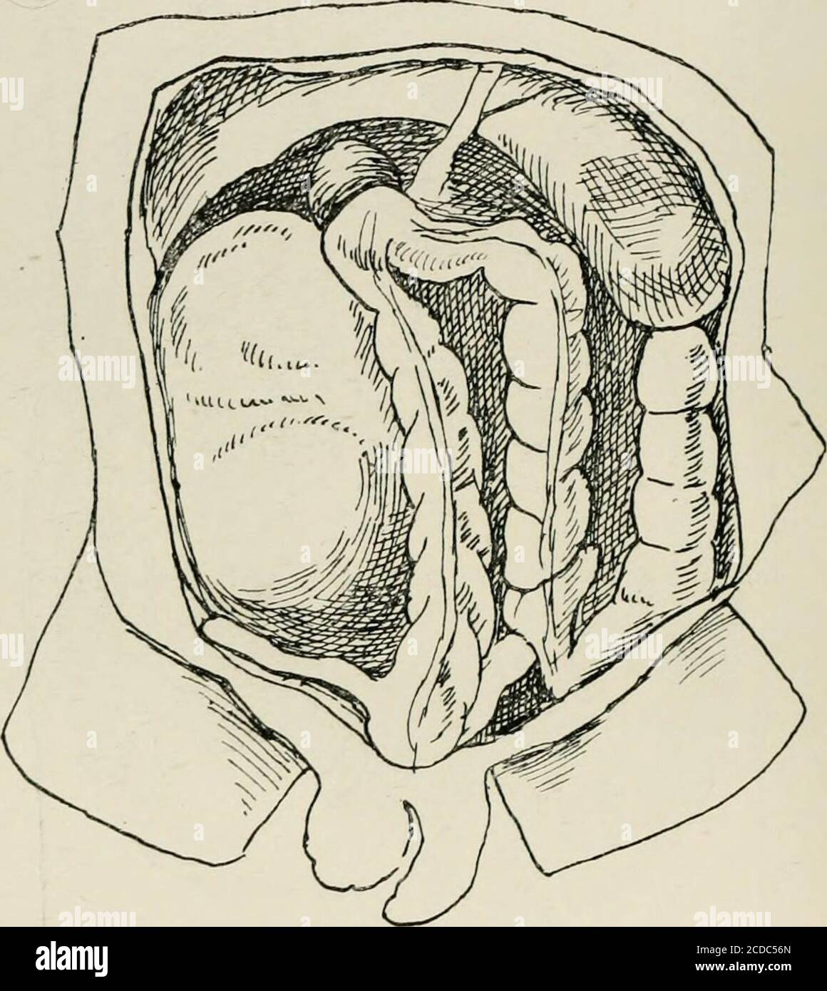 A La Fois De Lileon Et Du Caecum Synonyme Sur la hernie rétro-péritonéale . Figure 18. — Duodénal droit Hknnia.le sac  est entouré par le côlon. Le cou du sac, etc.—maintenant, j'ai déjà montré  la thatine exactement la situation où