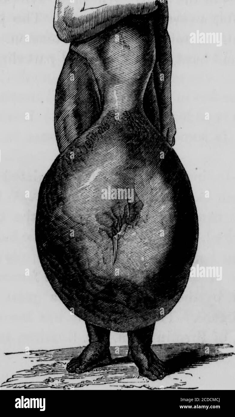 . Manuel des maladies de la peau pour les étudiants et les praticiens . Elekantiasis du pied et de la jambe. Après plusieurs rechutes, l'enflure augmente beaucoup, elle est molle et se met sous pression. À longueur la peau est blanche et brillante, ou elle est d'une couleur sombre, beaucoup épaissie et clouée avec des veines projetant; l'enflure est maintenant immenseet assez dur. ELEKANTIASIS AKABUM. 215 les glandes lymphatiques souvent suppurées ou boulées, les jointsare parfois envahi par l'inflammation chronique, et theskin peut devenir couvert d'écailles comme dans l'ichtyose, des ulcères insolubles ormalsains peuvent se produire. Souvent, comment-ev Banque D'Images