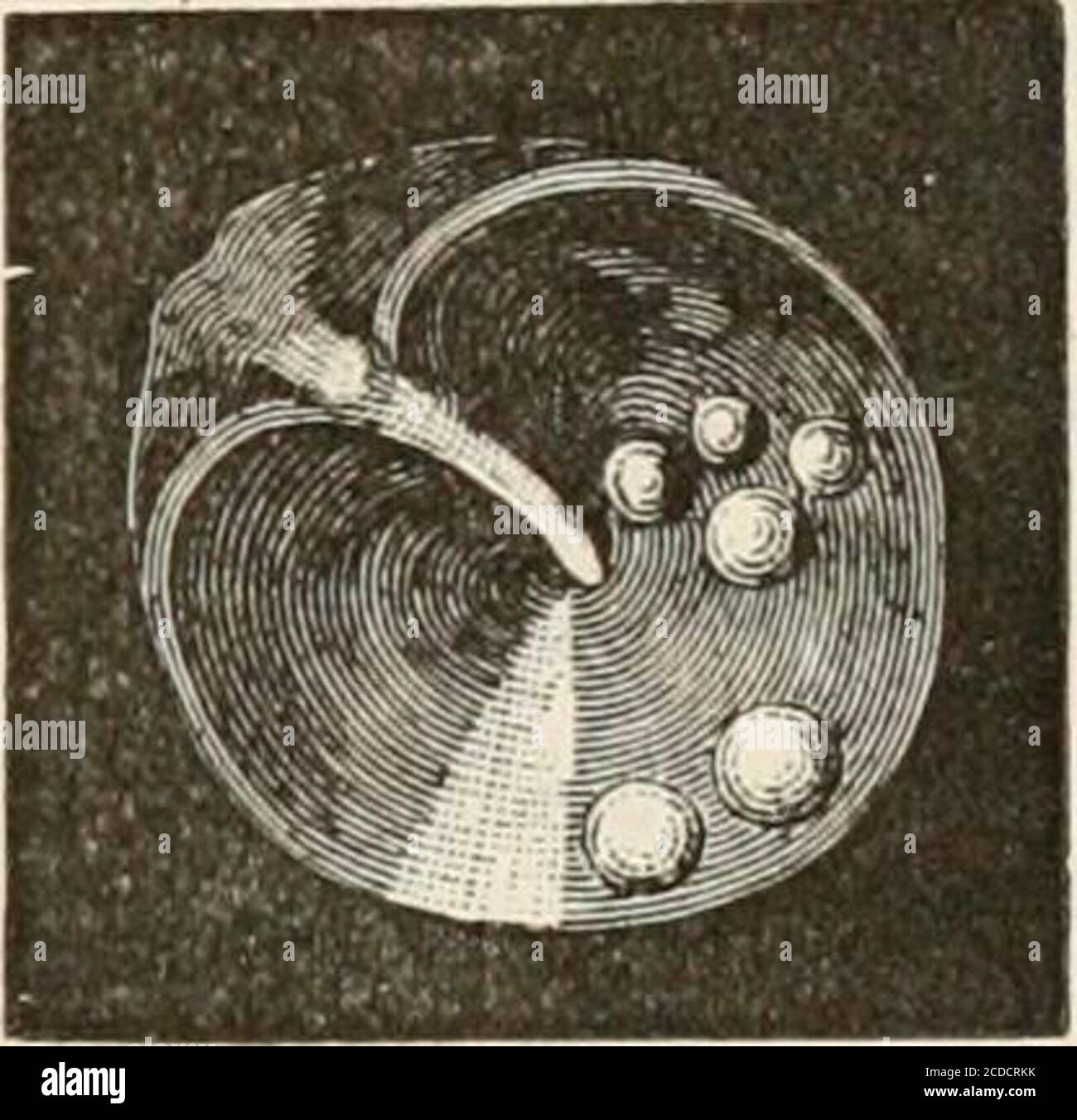 L'anatomie pathologique de l'oreille . Figure 49.. LE TAMBOUR-MEMBRANE. 87  muqueuse de la membrane du tambour. Ils sont vus ex-ceptionnellement sur le  skm sous la forme de corps cirtcrit, dur, brillant