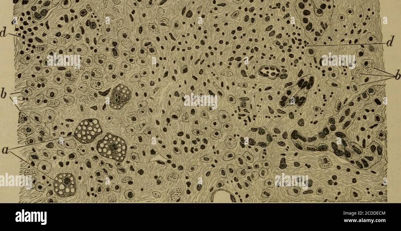 . Les éléments de l'histologie pathologique avec une référence spéciale aux méthodes pratiques . 0 « .V. Figure 123.—atrophie aiguë jaune du foie (à partir d'un endroit où l'on montre RedAtrophie), x 330. (Alum cochineal.) a, cellules graisseuses dégénérées du foie, certaines avec andsome sans noyau ; 0, cellules hépatiques atrophiques, partiellement remplies de pigment biliaire granulaire ; c, voies biliaires nouvellement formées ; d, stroma, infiltré avec de petites cellules. Les canaux biliaires, sont probablement considérés comme le résultat d'un rcyenerativetrowth sur la partie de l'épithélium qui tapisse l'ancien canalicule biliaire. La dégénérescence graisseuse ne doit pas être confondue avec le méchant graisseux Banque D'Images