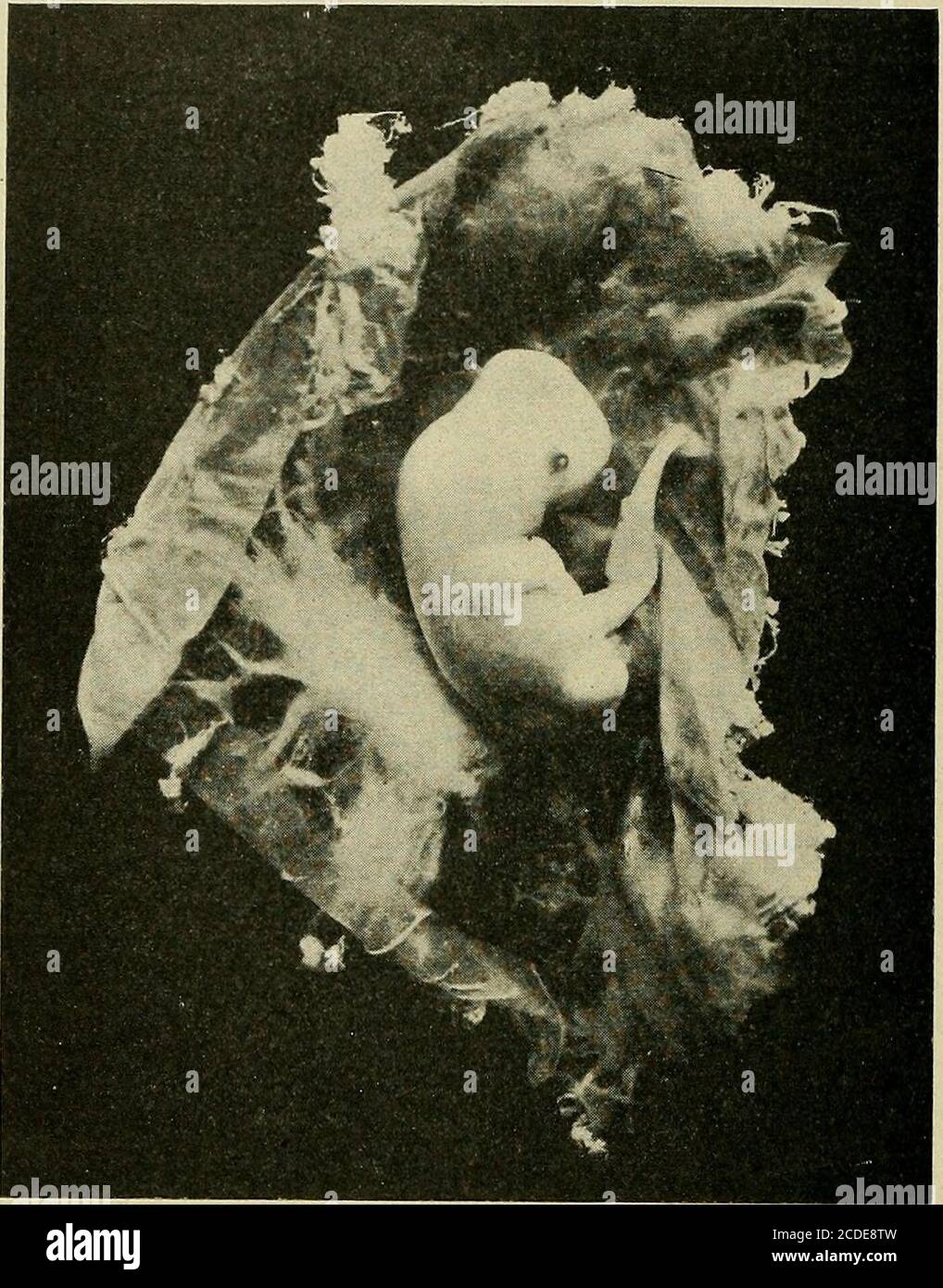 . Une étude des causes sous-jacentes à l'origine des monstres humains : troisième contribution à l'étude de la pathologie des embryons humains . distendendeavec le sang. Le foie est nécrotique. Devant la tête, le tissu est brisé, laissant une poche qui contenait l'avant-cerveau. Au-dessus de cela, le cerveau dépasse. Le cordon et le quatrième ventricule sont distendus et dissociés. L'épidermisis intact. N° 344. Ovule, 45 x 45 x 45 mm ; embryon, C.R., 16 mm. Professeur Minot. La paroi du chorion est très mince, avec quelques fibrosvilli éparpillés. Il ne contient pas de vaisseaux sanguins. Thelong mince ombilical co Banque D'Images