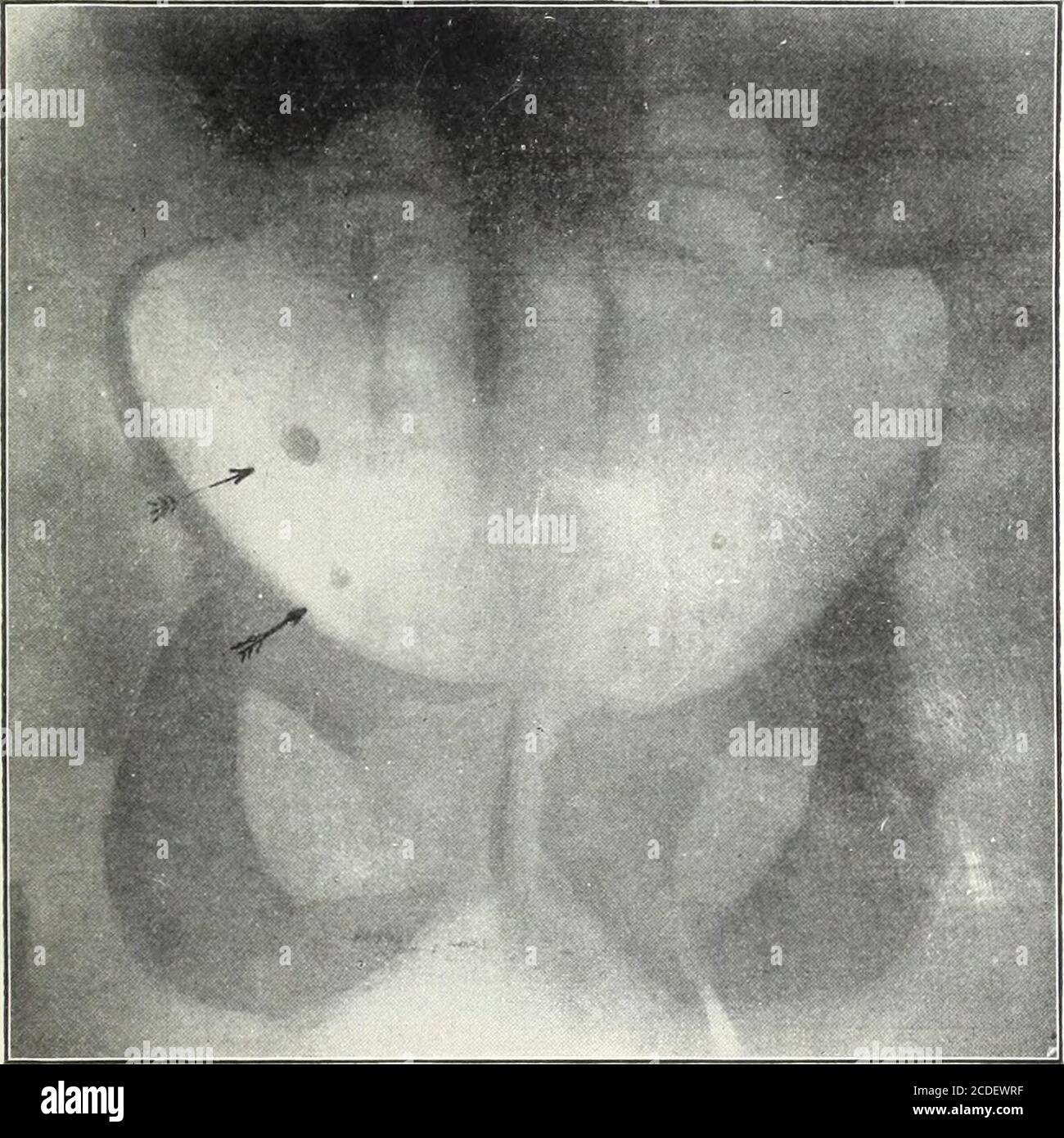 . L'âge médical : un journal semestriel de médecine et de chirurgie . .—Pierre dans la vessie. (Laboratoire de radiologie de Milwaukee.) Le travail de Henry Morris, père de la néphrolithotomie, et qui a incisé le rein plus de quarante fois avant-pierre, quand tous les symptômes cliniques étaient présents, sans findingle calcul, illustre magnifiquement la nécessité d'une méthode plus précis de diagnostic. L'utilisation réussie de la .r-ray a fait disparaître le neces-sity d'une incision diagnostique pour le calcul rénal et urétéral avec son ORIGINAL :-HA J ES 763 risques, et a rendu le diagnostic possible dans TH Banque D'Images