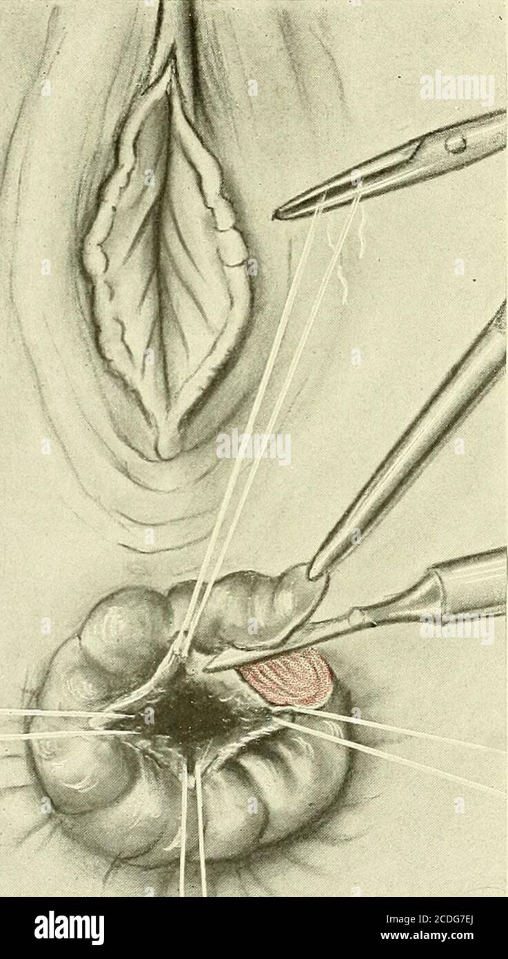 Gynecologie L Hemorroide A Ete Dissequee Et Son Pedicule Est Lie La Plaie Peut Etre Perlee Avec Une Fine Suture De L Intestin De Chat Ou Elle Peut Etre Laissee Sans