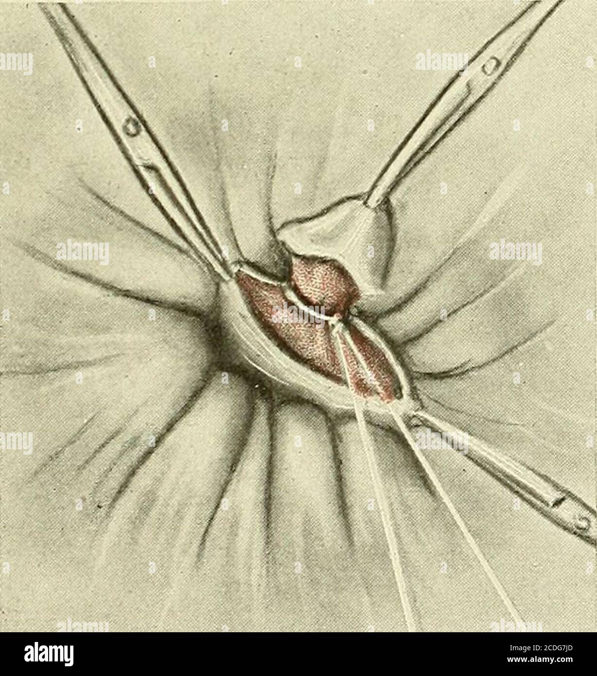 Gynecologie L Hemorroide A Ete Dissequee Et Son Pedicule Est Lie La Plaie Peut Etre Perlee Avec Une Fine Suture De L Intestin De Chat Ou Elle Peut Etre Laissee Sans