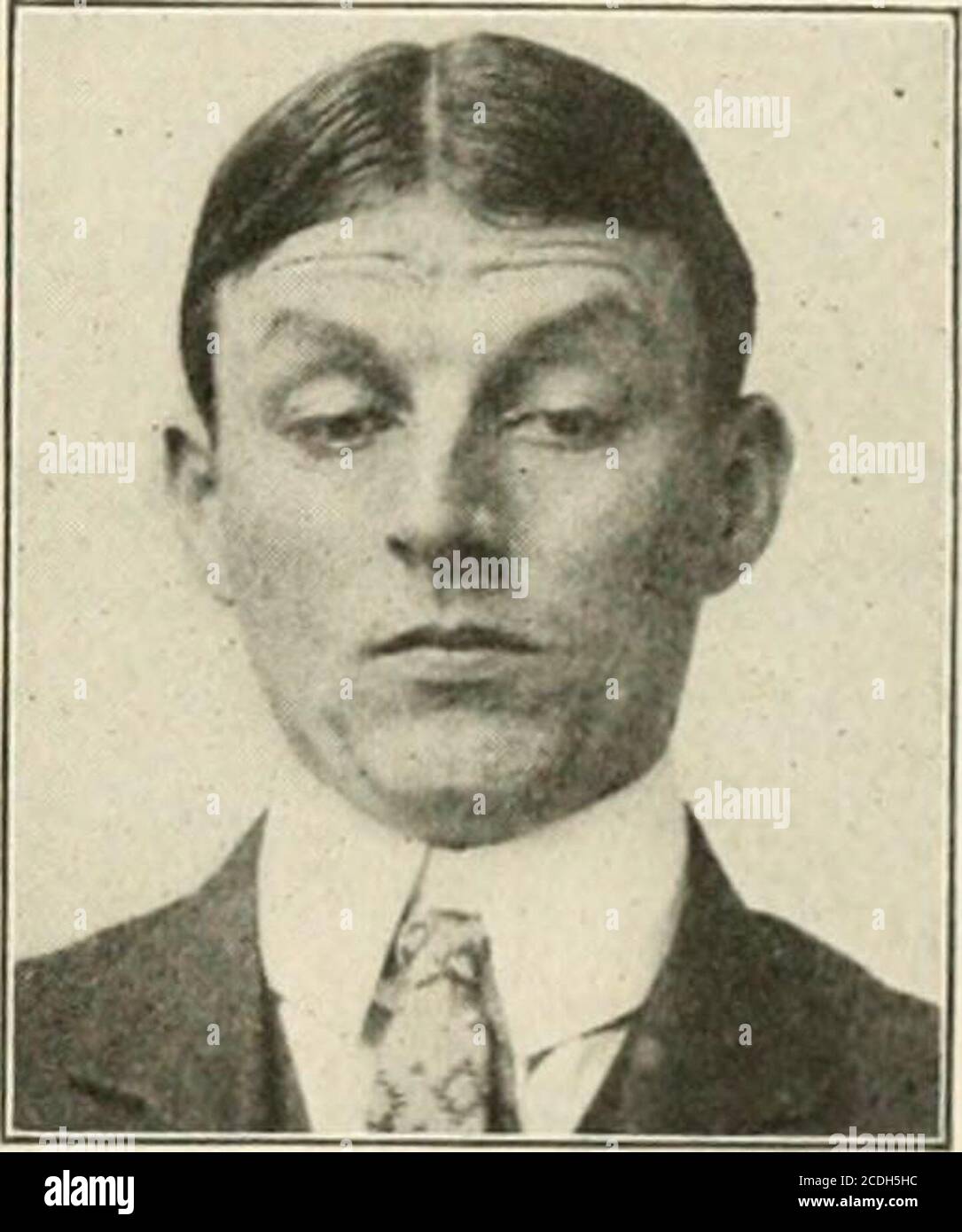 Ptosis Eye Banque D Image Et Photos Alamy Ptosis Eye Banque D Image Et Photos Alamy
