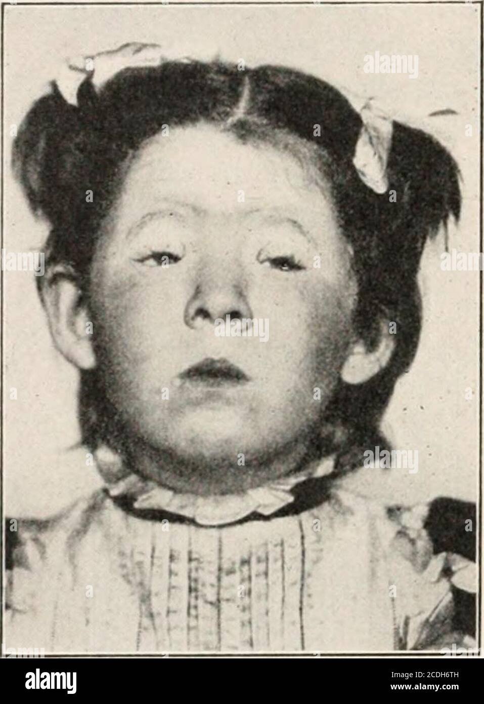 Ptosis Eye Banque D Image Et Photos Alamy Ptosis Eye Banque D Image Et Photos Alamy
