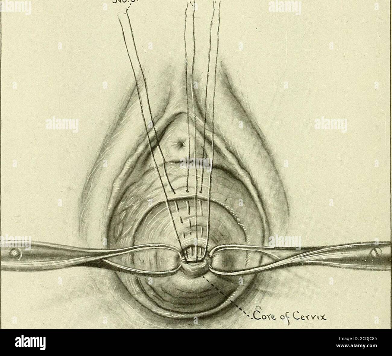 . Gynécologie : . Figure 234.—amputation du col de l'utérus.le col de l'utérus allongé, semblable à un cône, a été dépouillé de son lit et est maintenant prêt pour l'amputation. Le noyau tubulaire est amputé par une incision en forme de coin, de sorte que la pou-tion utérine sera convexe. Il s'agit d'une manœuvre importante, car elle laisse une souche conveniente pour l'insertion de points de suture à travers la muqueuse cervicale mém-brane, la souche étant maintenue vers l'avant par les deux forceps de traction. Si cette précaution n'est pas prise, la muqueuse cervicale se rétracte fortement 602 GYNÉCOLOGIQUE en arrière, et être tellement caché de la vue qu'il est difficile de pla Banque D'Images