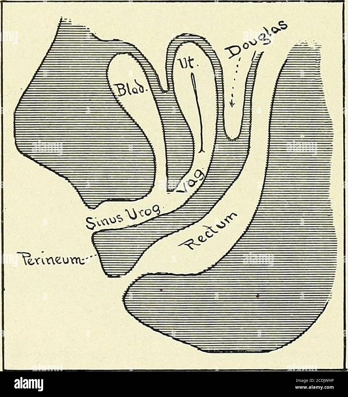 . Gynécologie : . Figure 180.—le sinus urogénital s'est brisé à travers la membrane cloacale. L'intestin est fermé. Les canaux Miilleriens ont atteint le sinus urogénital jusqu'au côté médian des canaux Wolffiens, mais n'ont pas encore acquis de lumière ouverte. Le site de l'avenir hymen isindiqué. L'uretère s'est séparé du conduit Wolffian. La partie entre les canaux de l'uretère et de Mullers devient la partie inférieure de la vessie et de l'urètre. La poche de Douglas est diquée entre l'intestin et le sinus urogénital. La partie ombrée qui dépasse à gauche du schéma représente le tube génital Banque D'Images