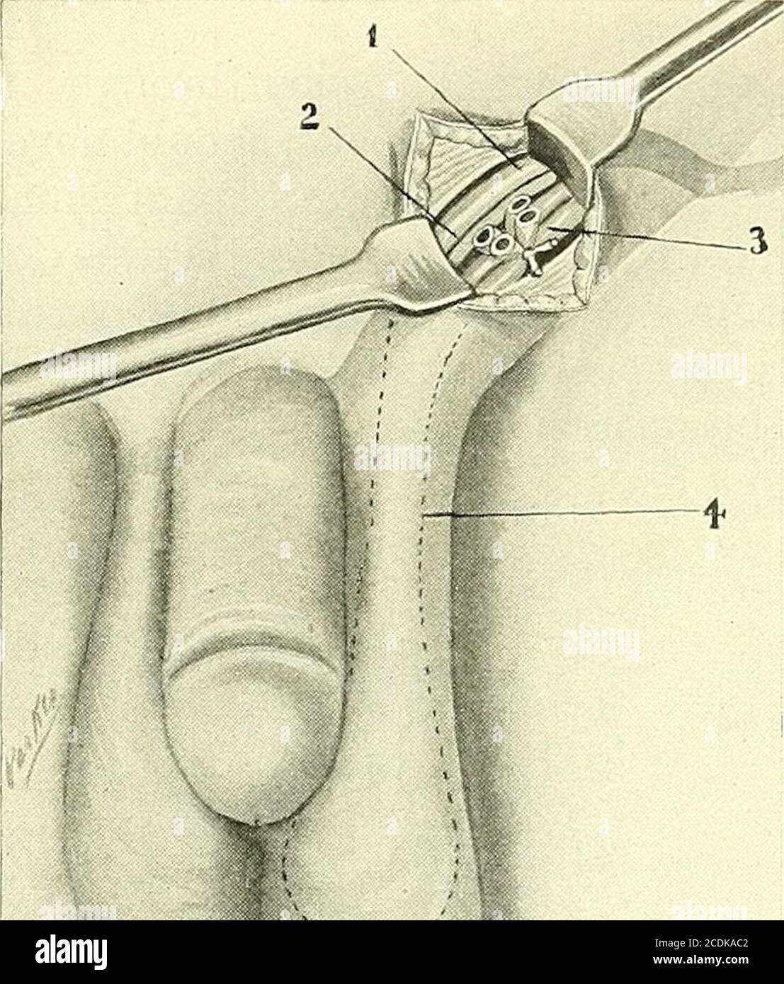 Chirurgie, ses principes et sa pratique . F LE SCROTUM, LE TESTICULE, ET LE  CORDON. Endommager le testicule ou interférer avec sa fonction. Environ  deux pouces des veines sont inclus entre