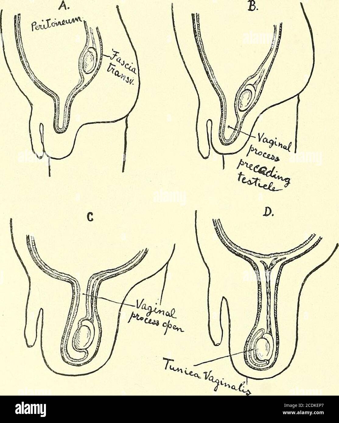 . Chirurgie, ses principes et sa pratique . Figure 309.—descente du testicule en trois étapes. Le processus du péritoine et du testicule de gubernaculum précédant le testicule dans le scrotum. Descend progressivement de sa position initiale sous le rein, entre 592 CHIRURGIE DU SCROTUM, DU TESTICULE et DU CORDON. Et passe par le canal inguinal, et le scrotum devient l'itshabitat. Le gubernaculum reste au pôle inférieur du testicule sous le ligament scrotal. Dans ce processus de descente il y a une période au cours de laquelle la poche péritonéalle dans le scrotum communique librement avec le periton général Banque D'Images