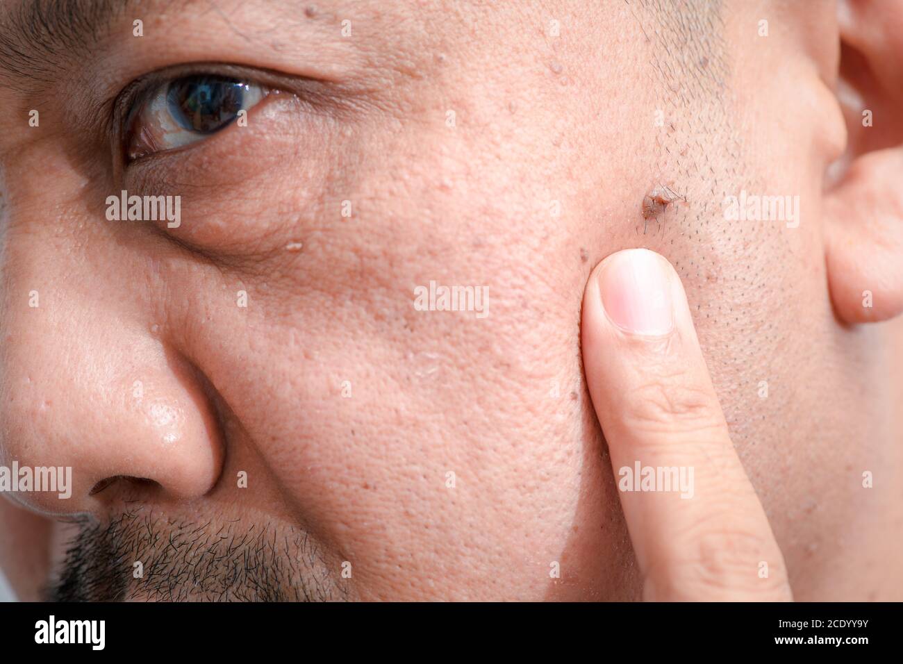 Fermé de grandes étiquettes de peau ou Acrochordon sur le visage de l'homme asiatique d'âge moyen, concept de soins de santé Banque D'Images