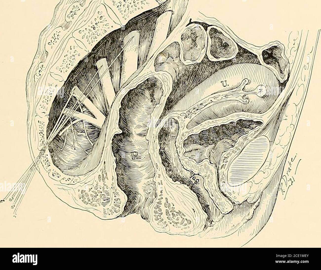 . Anesthésie régionale : son application technique et clinique . Figure 204.—Bloc présacré. Sur le côté gauche, l'aiguille entre en contact avec la partie supérieure du sacrum avant d'être avancée sur la partie antérieure de l'os. Sur la droite, theneedle a atteint l'art. Notez sa direction, qui est toujours parallèle à la ligne médiane. Le second foramen sacré (Fig. 204). La distance totale entre la seconde et le cinquième foramen est injectée avec 20 c.c. de la solution à 1 %. Aucune injection ne doit être effectuée avant le contact avec l'isfeutre osseux. L'aiguille est alors retirée et l'aiguille N° 5 (12 cm) est intro-dusée Banque D'Images