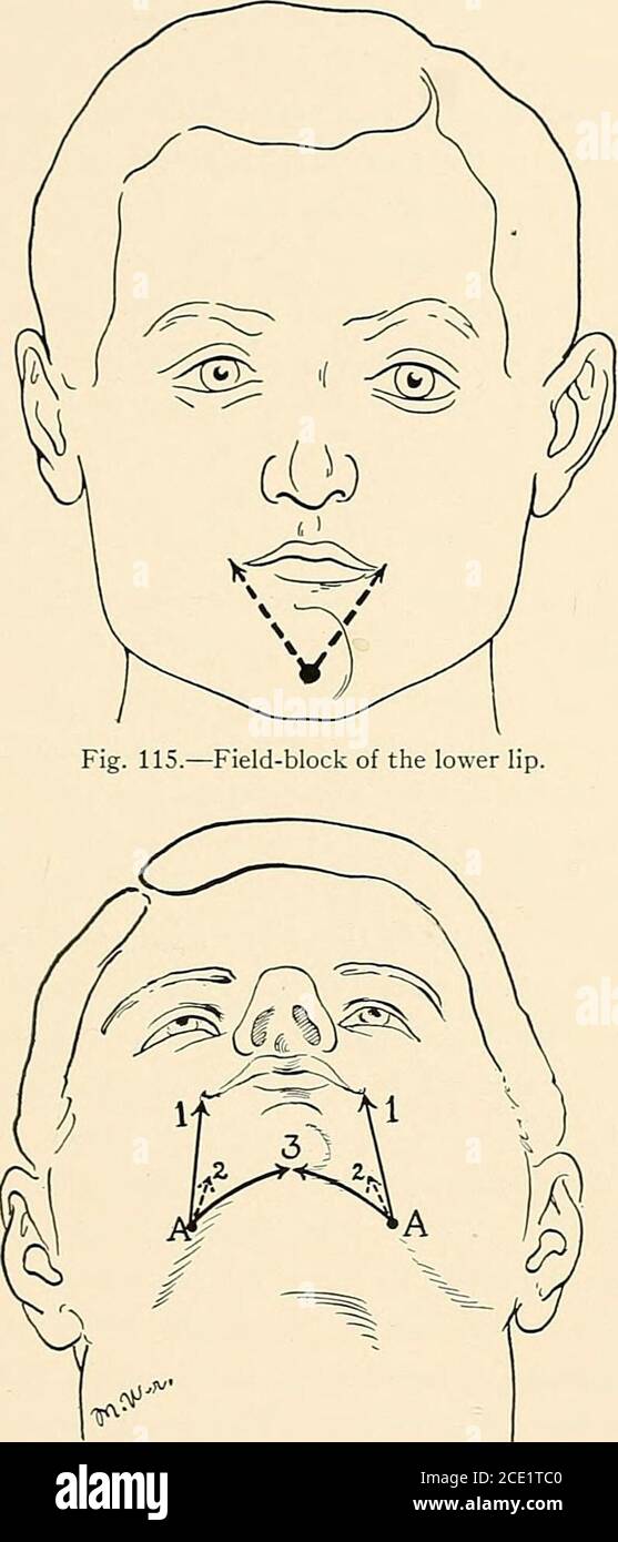 . Anesthésie régionale son application technique et clinique . Fig. Lu.—Bloc de champ de la
