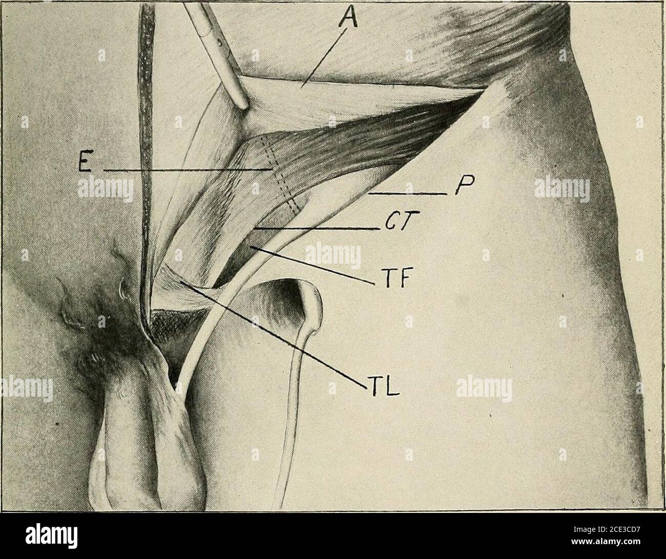 . Chirurgie opérative, pour les étudiants et les praticiens . iccord, dans le mâle; le ligament rond, dans la femelle. La coupe égesde l'aponeurosis doit être saisie avec des pinces d'artère et séparatelibrement des parties sous-jacentes avec le doigt. La spermaticcule est une structure aussi grande que le petit doigt. Il est composé du canal déférent, qui est le canal efférent du testicule; le thérotère du canal déférent et de l'artère crémarique, et les veines correspondantes; l'artère spermatique, et le plexus pampiniformenoveineux. Comme ces structures traversent le canal inguinal theyare tous liés t Banque D'Images