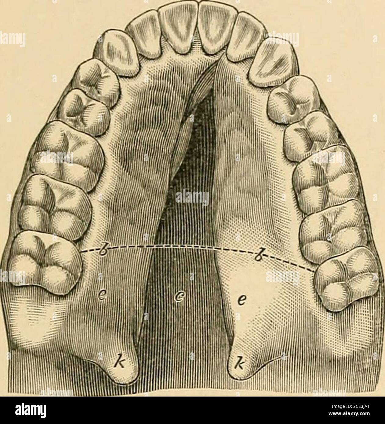 Un manuel de la dentisterie mécanique et de la métallurgie . Figure 76  représente un modèle de palais fissuré, avec une lèvre de lièvre sur le  côté gauche de la ligne