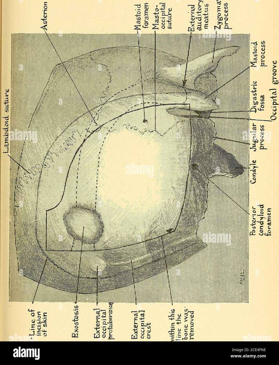 . Quelques points dans la chirurgie du cerveau et de ses membranes . Figure 141.—Photographie de la tumeur immédiatement après son retrait. DE TUMEUR DU CERVEAU 279. Figure 142.—dessin de la région occipitale droite du crâne, montrant le contour du lambeau de cuir chevelu, la portion de l'os enlevée, le cours du sinus sigmoïde et le site de l'exostose. 28o QUELQUES POINTS DANS L'opération CHIRURGICALE^ 19 novembre 1894.—lambeau de cuir chevelu trelenné dans la région occipitale droite et os enlevé.vers la protubérance occipitale externe une exostosisa été découvert et enlevé. L'exostose présentéevers la dure aussi bien que l'externe Banque D'Images