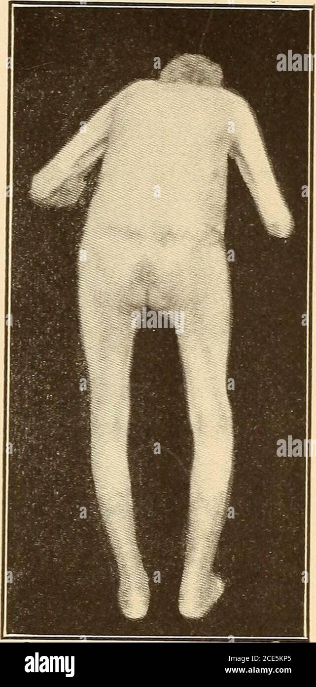 . Gériatrie; les maladies de la vieillesse et leur traitement, y compris la vieillesse physiologique, les soins à domicile et en établissement, et les relations médico-légales . Pseudo-pagets maladie. Nouvelle Iconographie de la Salpetriere, janvier-février 1905. DÉGÉNÉRESCENCE SÉNILE DU CERVEAU 139 la culpabilité montre une puissance diminuée même avant l'achèvement du développement. Étiologie.—la diminution du poids du cerveau mendiennormalement vers la fin de la quatrième décennie de vie, peu après, a atteint son plus grand poids et des années avant que l'atrophe puisse raisonnablement être chargé de la nutrition diminuée de l'artériosclero cérébral Banque D'Images
