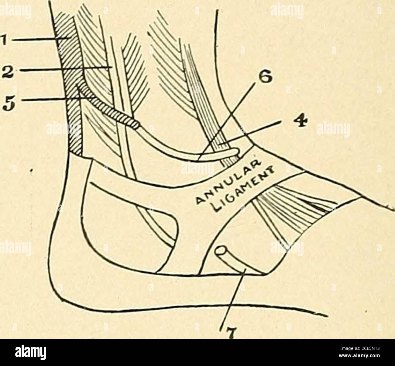 . La pratique américaine de la chirurgie ; un système complet de la science et de l'art de la chirurgie . Figure 113. Fig. 114. Fig. 113 et 114.—schémas illustrant la méthode de greffage des tendons. (Binuie: Manuel de chirurgie Opera-tive.) 1, Tendo Achilis; 2, peroneus longus; 3, peroneus brevis; 4, tendons extenseurs; 5,glissement du tendo Achilis; 6, tendon de peroneus breis utilisé comme greffe; 7, extrémité distale du tendonon divisé du péronus brevis. 3. Talipes Equino-Varus, une difformité paralytique commune due à la parésie du groupe tibial antérieur des muscles, avec affaiblissement du groupe péronier.—dans cette condition, la moitié externe Banque D'Images