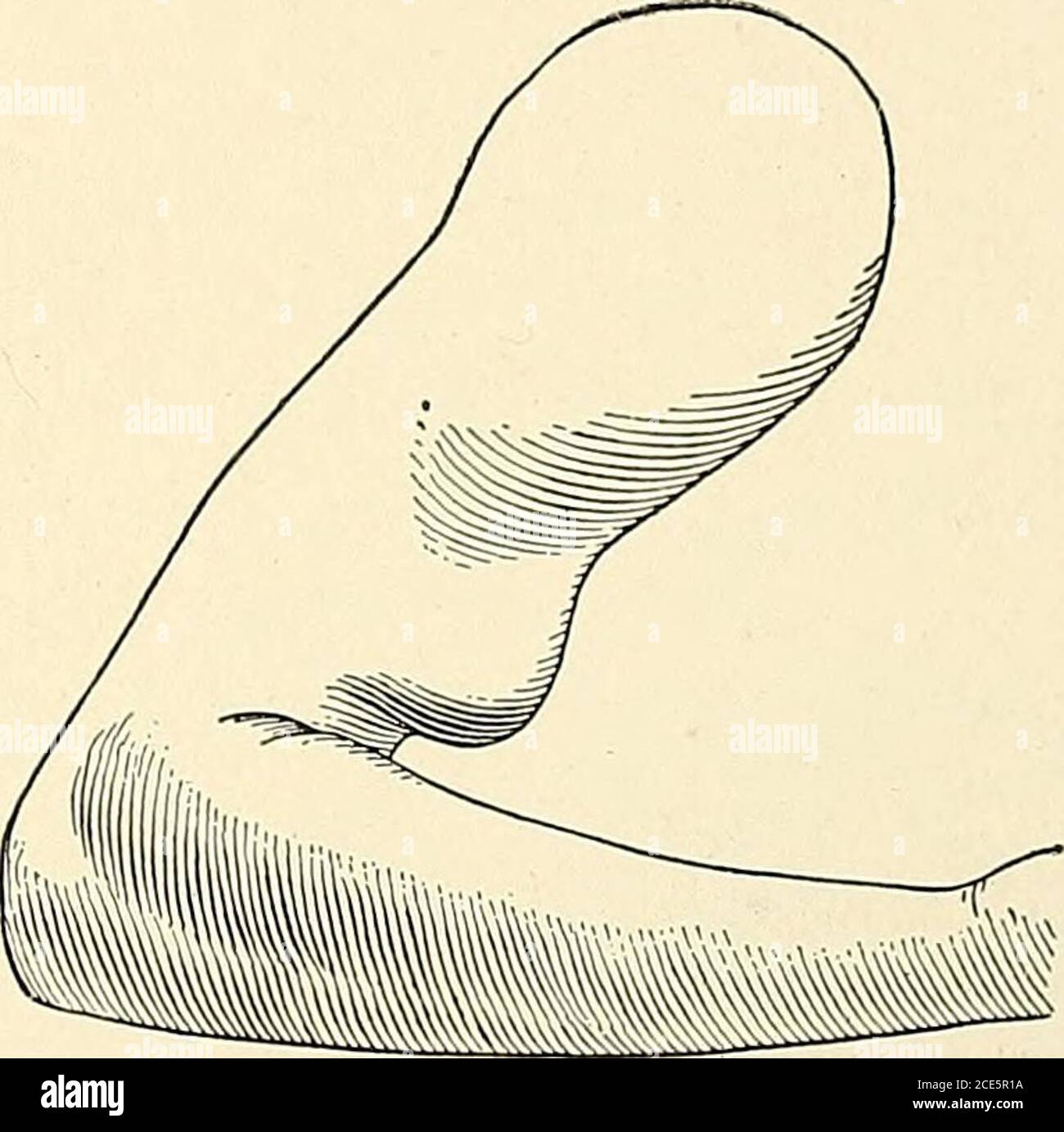 . La pratique américaine de la chirurgie ; un système complet de la science et de l'art de la chirurgie . Figure 59. Fig. 60. Diagrammes montrant une vue latérale d'un contrat normal (Fig. 59) et une rupture de biceps (Fig. 60; de von Bruns). Muscles. La rupture spontanée des muscles peut se produire à partir de n'importe quelle forme de sureffort ou même d'effort modéré dans certains cas de dégénérescence musculaire.équitation, saut, soulèvement de corps lourds, l'étirement passif d'un muscle serré-contracté, le tétanos, et la parturition ont tous été rapportés comme cause de rupture des muscles volontaires. La rupture spontanée d'un muscle peut.affecter Banque D'Images