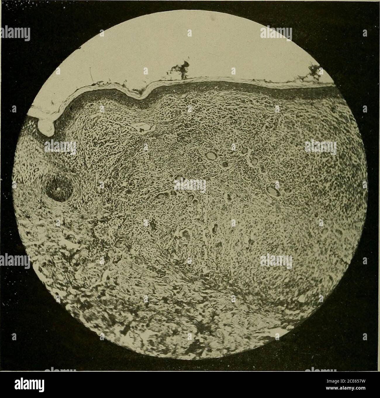 . Syphilis : un traité sur l'étiologie, la pathologie, le diagnostic, le pronostic, la prophylaxie et le traitement . Figure 62.—les syphiliHes nodulaires montrent des iniiltratinn nérivasculaires massifs. (Collection de Drs. Fordyce et MacKee.) Mycose fungoides commence par des lésions de type eczematose qui, de manière itchintense, plus tard de grandes tumeurs se développent rapidement. Epitheliomata de 136 SYPHILIS la variété basale-cellulaire se développe presque toujours à partir de lésions précancéreuses, souvent une kératose séborrhéique, et sont la plupart com-mon sur le visage. Ils poussent beaucoup plus lentement que les dosyphilides et ont pratiquement toujours un bord roulé dur usu-allié Banque D'Images
