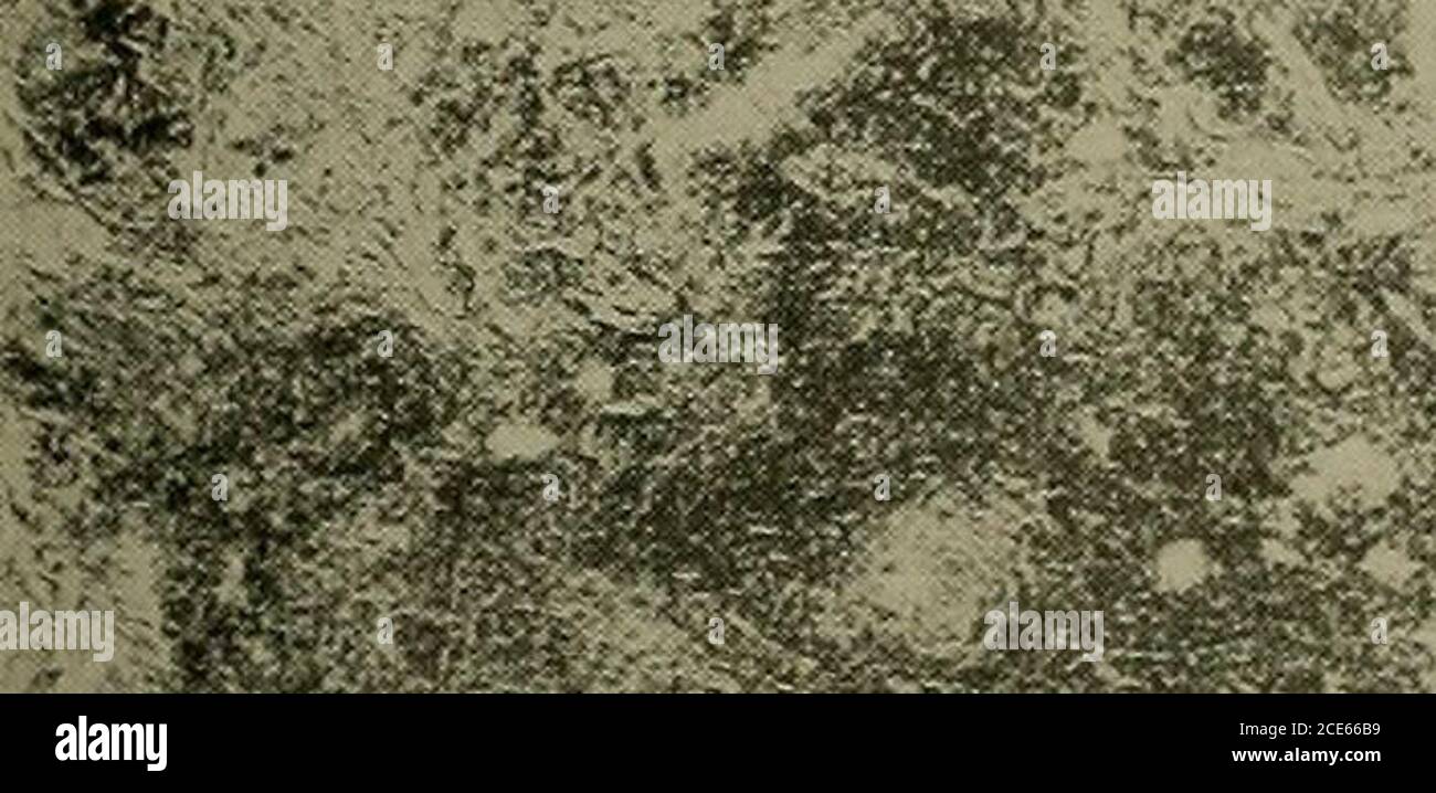 . Syphilis : un traité sur l'étiologie, la pathologie, le diagnostic, le pronostic, la prophylaxie et le traitement . ^^iw. Figure 62.—les syphiliHes nodulaires montrent des iniiltratinn nérivasculaires massifs. (Collection de Drs. Fordyce et MacKee.) Mycose fungoides commence par des lésions de type eczematose qui, de manière itchintense, plus tard de grandes tumeurs se développent rapidement. Epitheliomata de 136 SYPHILIS la variété basale-cellulaire se développe presque toujours à partir de lésions précancéreuses, souvent une kératose séborrhéique, et sont la plupart com-mon sur le visage. Ils poussent beaucoup plus lentement que les dosyphilides et ont pratiquement toujours un bord dur roulé u Banque D'Images