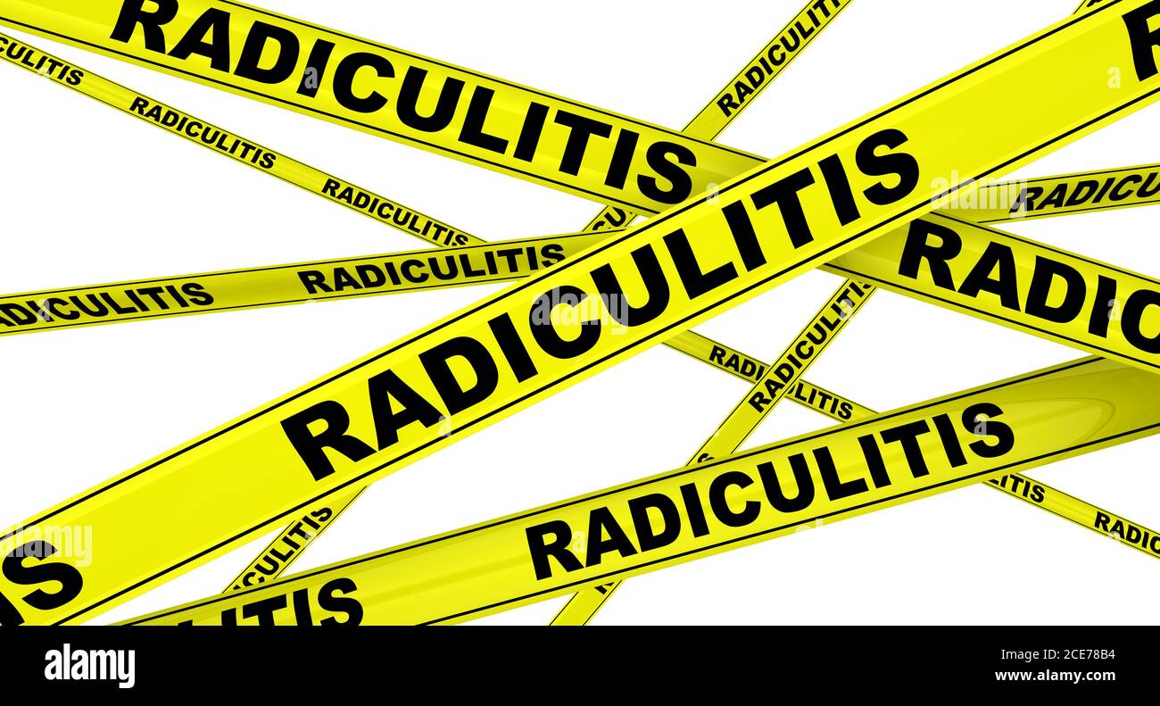 Radiculite. Rubans d'avertissement jaunes avec des mots noirs RADICHITIS (ou douleur radiculaire). Isolé. Illustration 3D Banque D'Images