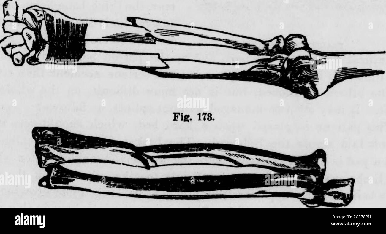 . Le médecin de famille hydropathique : Un prescripteur prêt et conseiller hygiénique en référence à la nature, les causes, la prévention, et le traitement des maladies, accidents, et les victimes de toutes sortes . ramolli, et impuissants, et par le crépitus qui est facilement senti.en le traitant, quatre attelles environ trois doigts de pain larges, avec des coussinets, sont nécessaires. Les électrodes doivent être un peu plus larges et plus longues que les électrodes, de sorte qu'elles puissent s'étendre sur l'extrémité pour être empilées rapidement. Après le premier gonflement est passé, la fracture est réduite en tirant lecoude vers le bas tandis que l'épaule est soutenue. Après t Banque D'Images