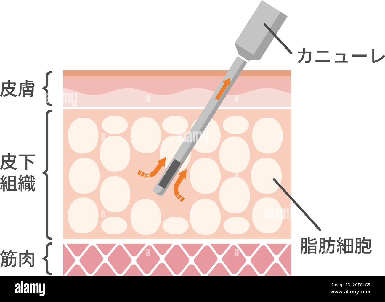 Illustration vectorielle du processus de liposuccion / vue en coupe de la peau Illustration de Vecteur