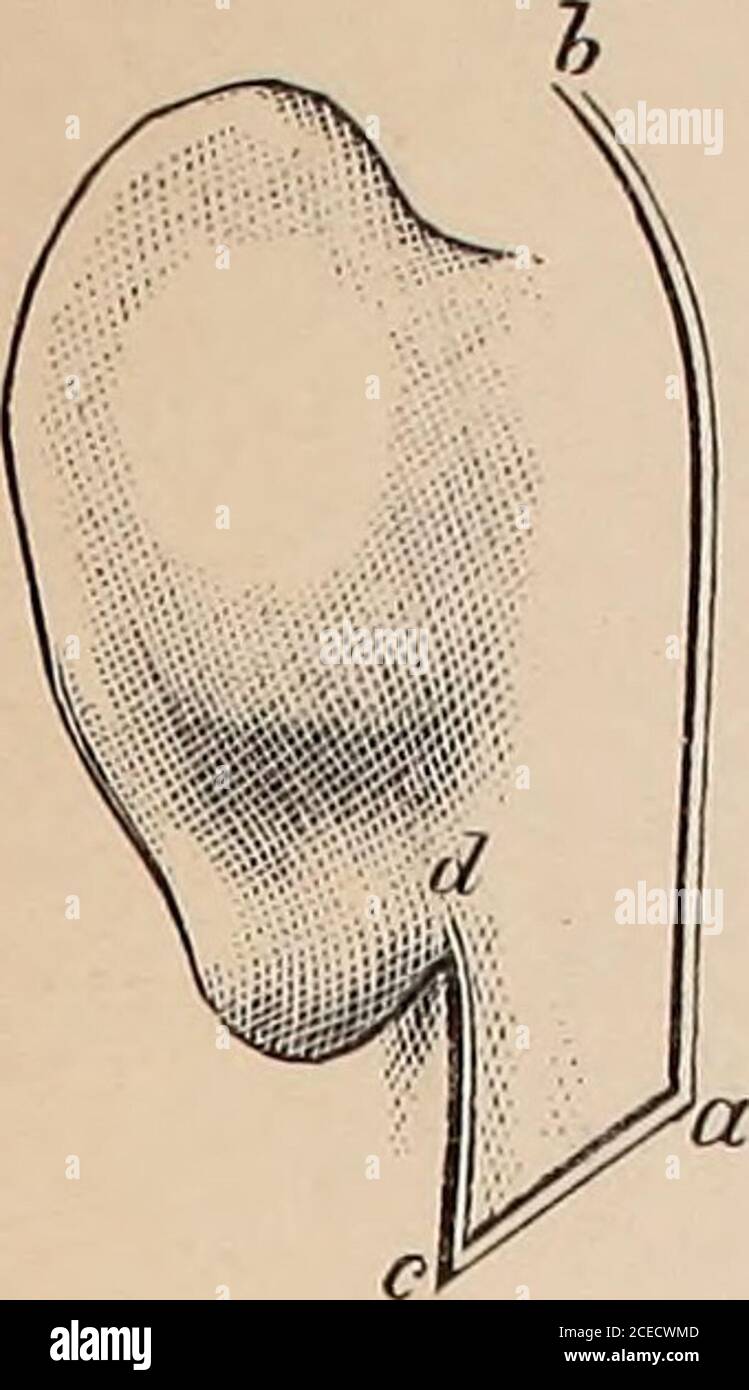 . Lehrbuch der Ohrenheilkunde für Ärzte und Studirende. essen (Kretschmann [6]). Figure 8. Kretschmanns [5 U. 6] Plastik (art. 295). aed oberer, abe unterer drei-eckiger Lappen aus der abgelösten Hautdecke der hinteren Gehörgangswand,durch horizontal Spaltung derselben entstanden. Der Spaltungsschnitt reichtnach aussen bis a d. h. bis zu einem ca. 7 mm von dem ersten die Muschelcircumeidirenden Hautschnitt (cab1) entfernten Punkt. Beim Vernähen derGehörgangslappen mit dem vorderen Wundrad des ersten retroauriculärenHautschnts (Umsäumung des vorderen Wundrands) kommt a auf «, b auf bc auf & Banque D'Images