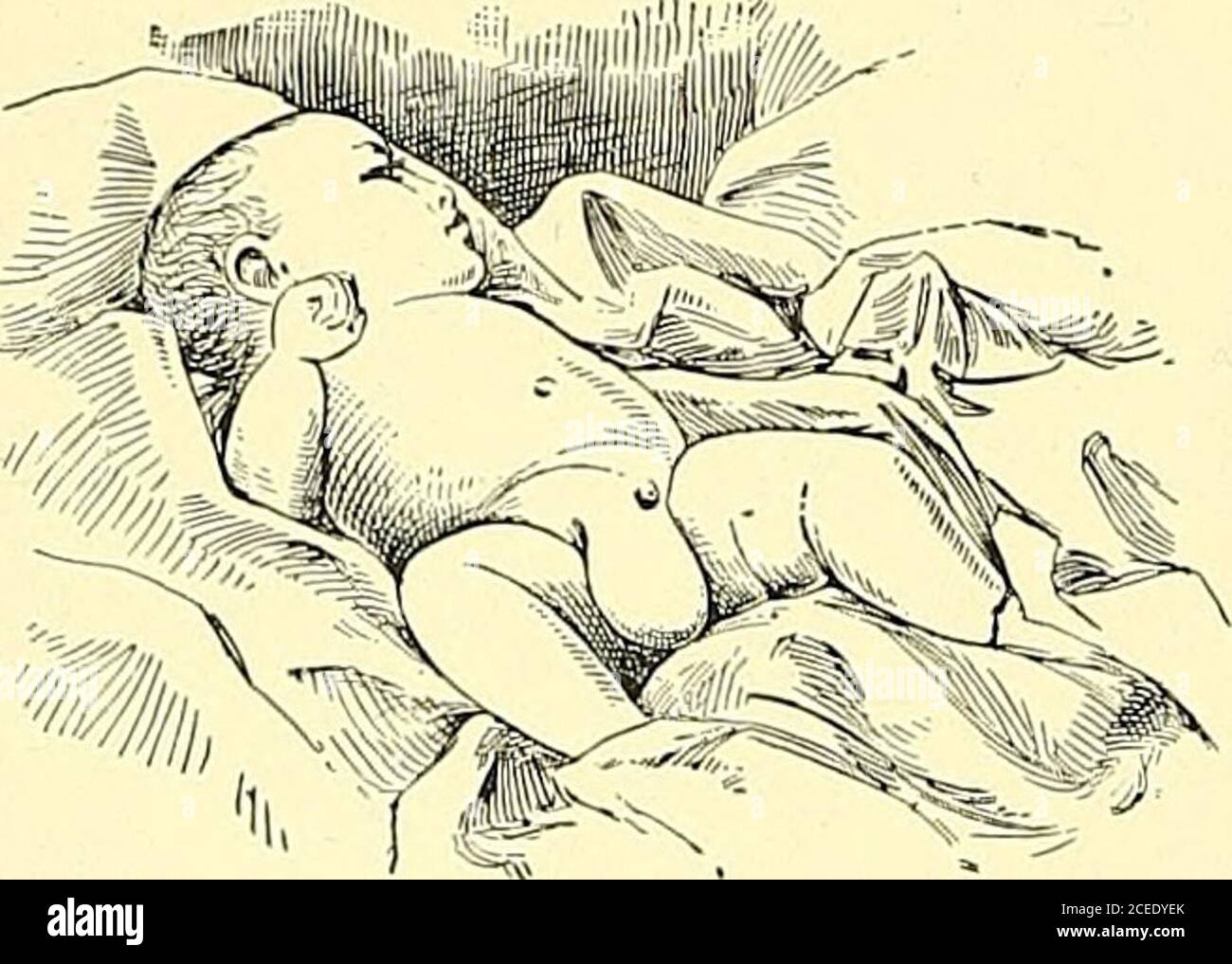 L Anatomie Et Le Traitement Chirurgical De La Hernie Ong Bebe Bien Developpe Sincebirth La Mere Avait Remarque Une Legere Enflure Du Scrotum Droit Parfois Presque Theser D Un Petit Poing La Tumeur