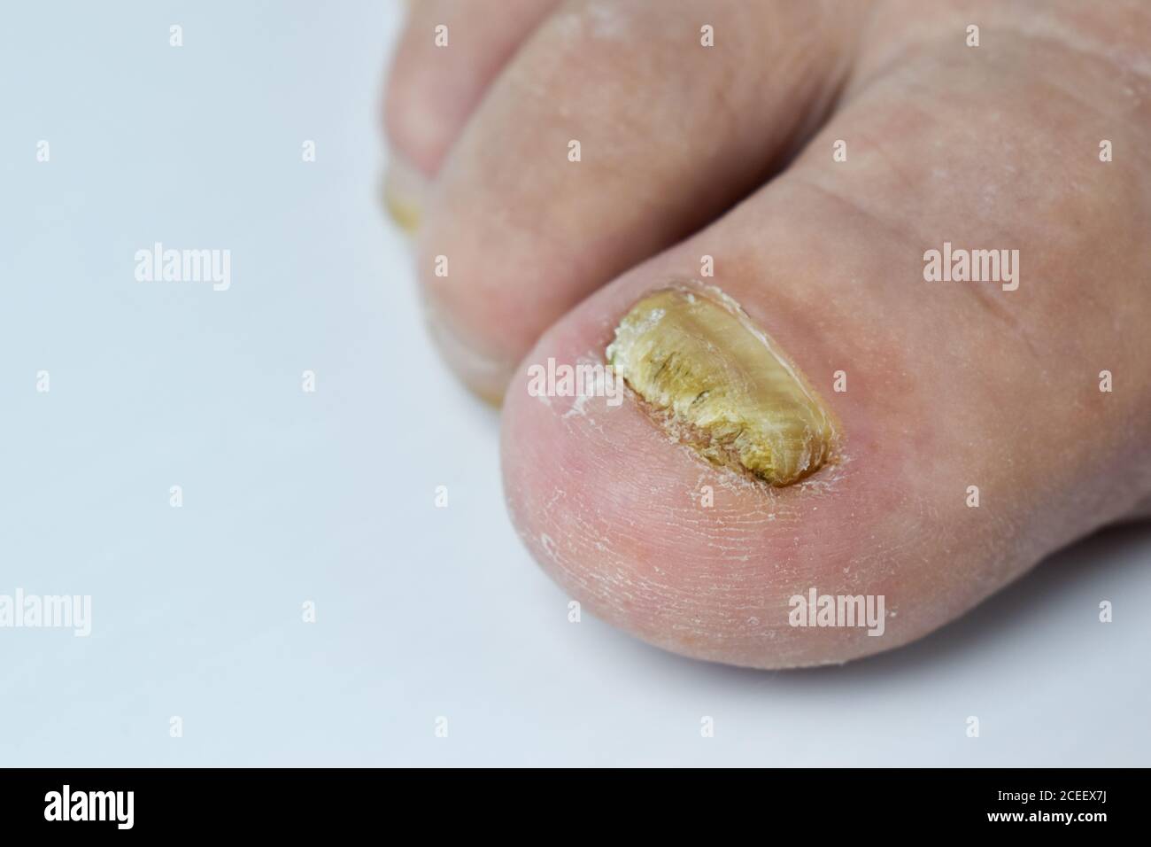 Champignon sur les ongles du pied gros plan sur fond blanc Banque D'Images