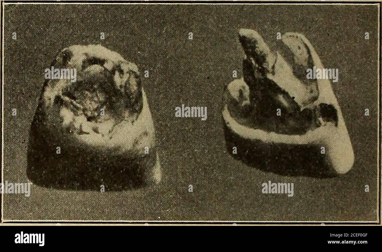 . Pathologie buccale et pratique. Un livre-texte à l'intention des étudiants des collèges dentaires et un manuel à l'intention des praticiens dentaires. Résorption des racines de „ T „ TT   résorption de la dent implantée, montrer les dents comme Lsually observé. inc. Aspects labiaux et linguaux. Dans ce dernier, la partie centrale projetée est le renversant de la racine gutta-percha. (Pratique du Dr William Jarvie.) Dans tous les cas de plantation de dents le succès final de l'opération doit dépendre soit de la réunion de tissus soussindesfr la croissance de nouveau. Les ostéoblastes peuvent exister n'importe où dans les sous-starrvr^e de l'os, ou Banque D'Images