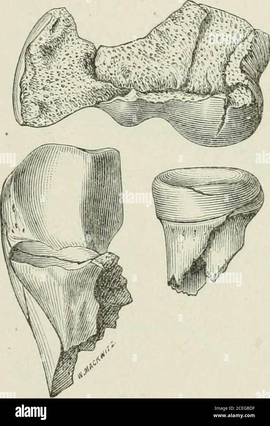 . Journal médical et chirurgical de Saint Louis. Mené; un certain mouvement à la cheville. Août 1878.—Je trouve que la femme marche maintenant sans 1878.] Mudd, ésection pour le Traimiatisme. 21^ soutien à la cheville; n'a pas de douleur; il y a un léger mouvement de la cheville, et le pied est parfait sauf en longueur et en mouvement. L'utérus, lors de sa première fabrication, a été lavé à l'eau simplement, plus tard, un chiffon graissé a été appliqué. H. S , âgé de 20 ans, a été blessé le 23 juillet 1875 par une machine en briques qui a écrasé le coude et cassé les deux bonesde l'avant-bras droit. Lors de l'examen, j'ai trouvé que therewa une blessure lacérée étendue, les deux Banque D'Images