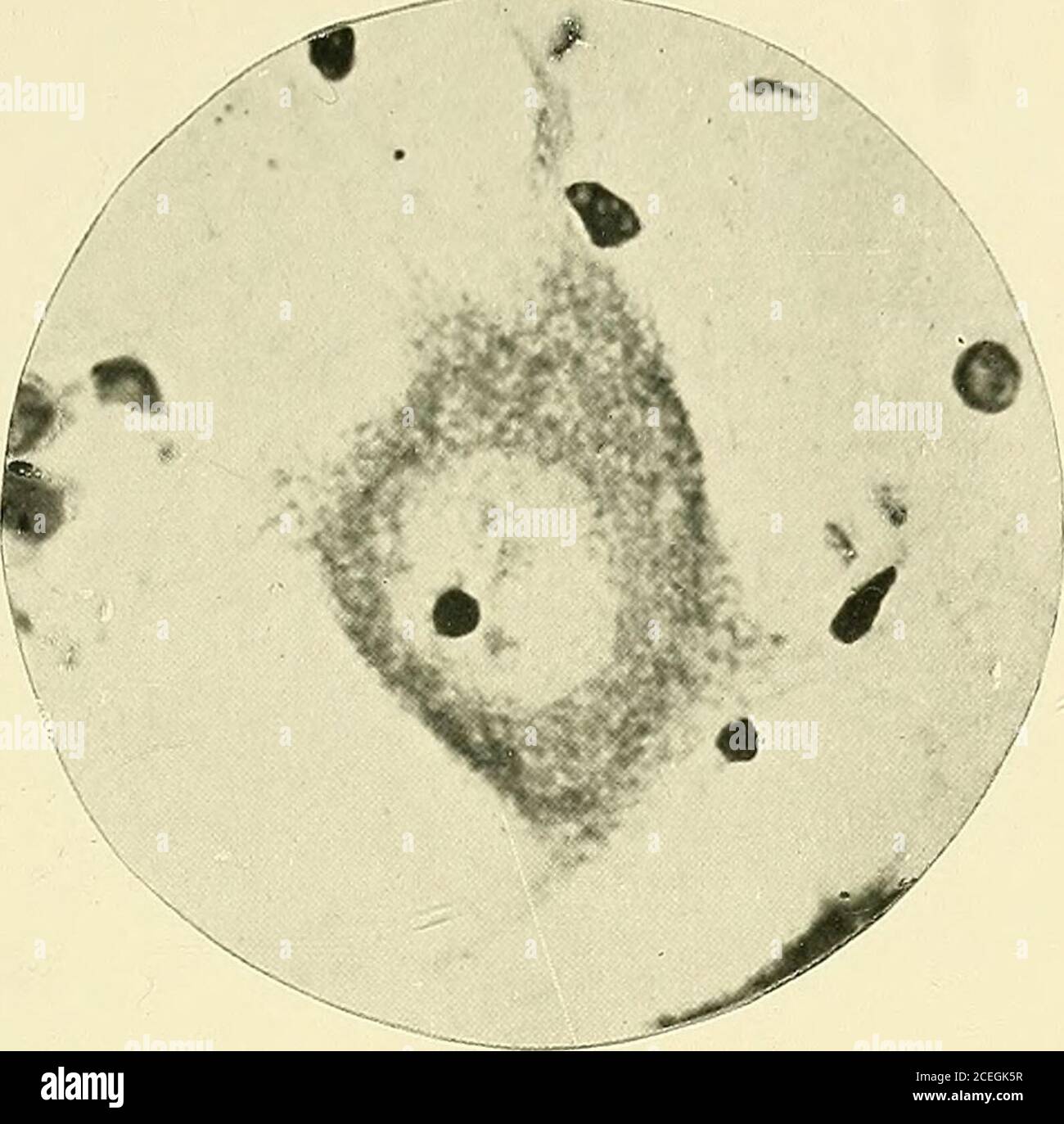 . L'épilepsie, une étude de la maladie idiopathique. On dans le nombre de granules. Dans les foliae atrophiés, selon l'étendue de la lésion, il n'y a que peu ou pas d'orgranules de cellules de Purkinje. Preuves de la coagulation intra-vasculaire (Fig. 6) sont abondants, et, bien que jusqu'à présent aucune démonstration réelle de rupture due à la circulation tobloquée a été rencontré ici, la zone souvent limitée, et toujours fortement définie, de l'atrophie est fortement dans le favoridede la lésion étant due à la privation de,l'approvisionnement en sang. Medulla oblongata. C'était le site favori pour la thélocalisation des lésions essentielles Banque D'Images