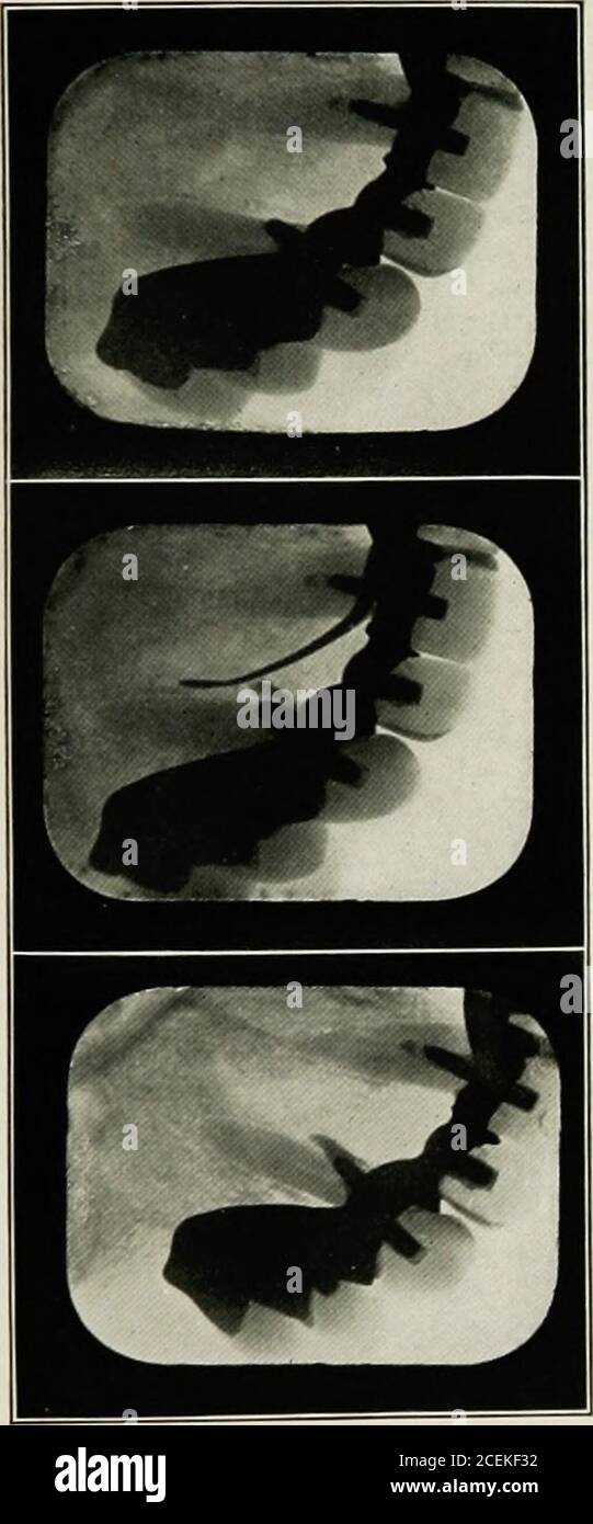 . Anesthésie orale; anesthésie locale dans la cavité buccale, technique et application pratique dans les différentes branches de la dentisterie. Le côté droit montre également un abcès chronique.le patient souffre de rhumatismes. N° 3. Abcès chronique sur le second bicuspide.petit kyste sur molaire de six ans. Les dents se sentent bien de temps en temps. Les abcès ne proviennent pas toujours de pulpes inu-périéléments, mais se produisent souvent sur le côté de la racine d'abcès des poches, des perforations ou des ma- teriaux étrangers. Ils doivent être curetés et nettoyés, ce qui est Banque D'Images