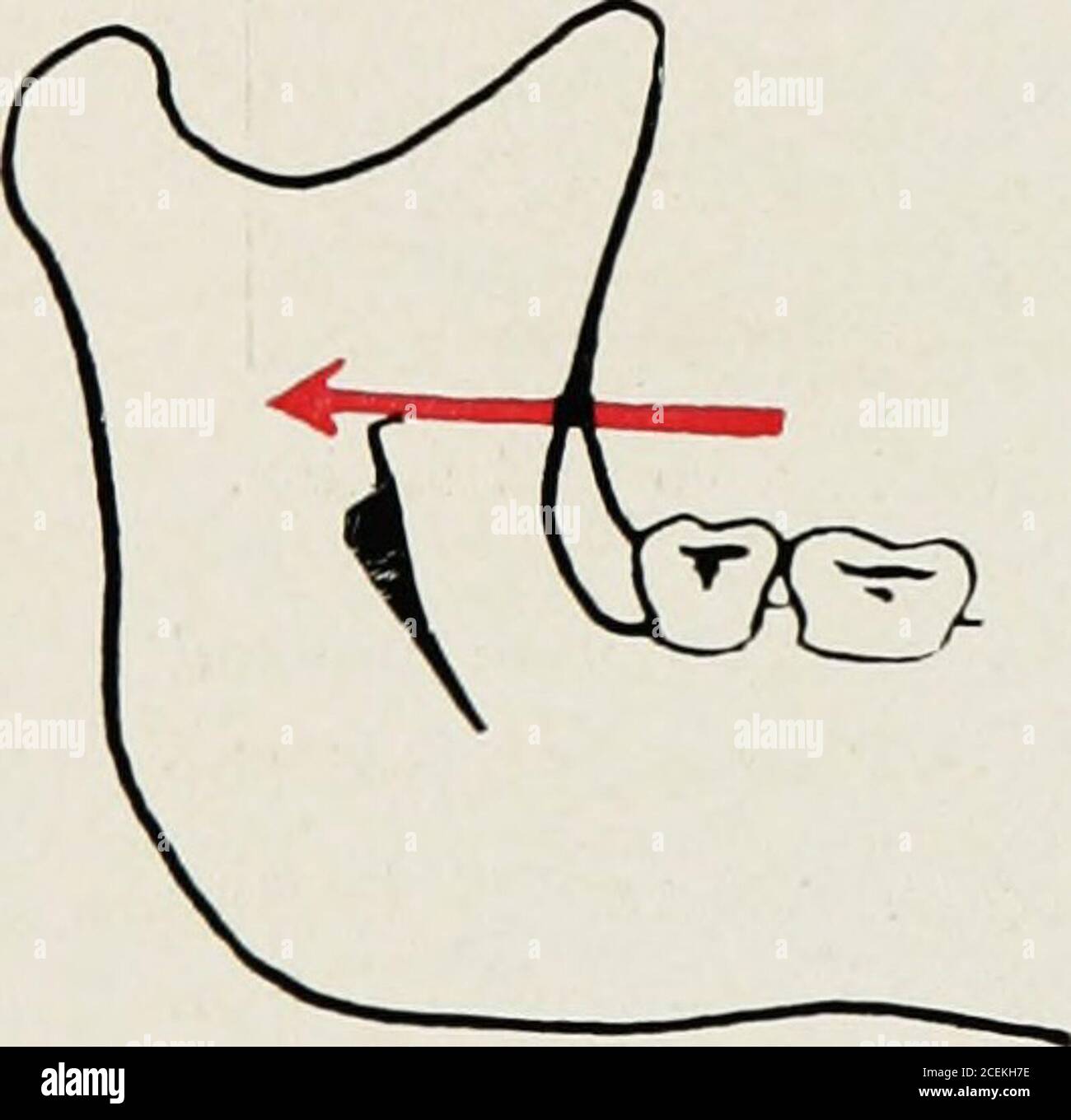 . Anesthésie orale; anesthésie locale dans la cavité buccale, technique et application pratique dans les différentes branches de la dentisterie. TIG- 2.. TG 5. Banque D'Images