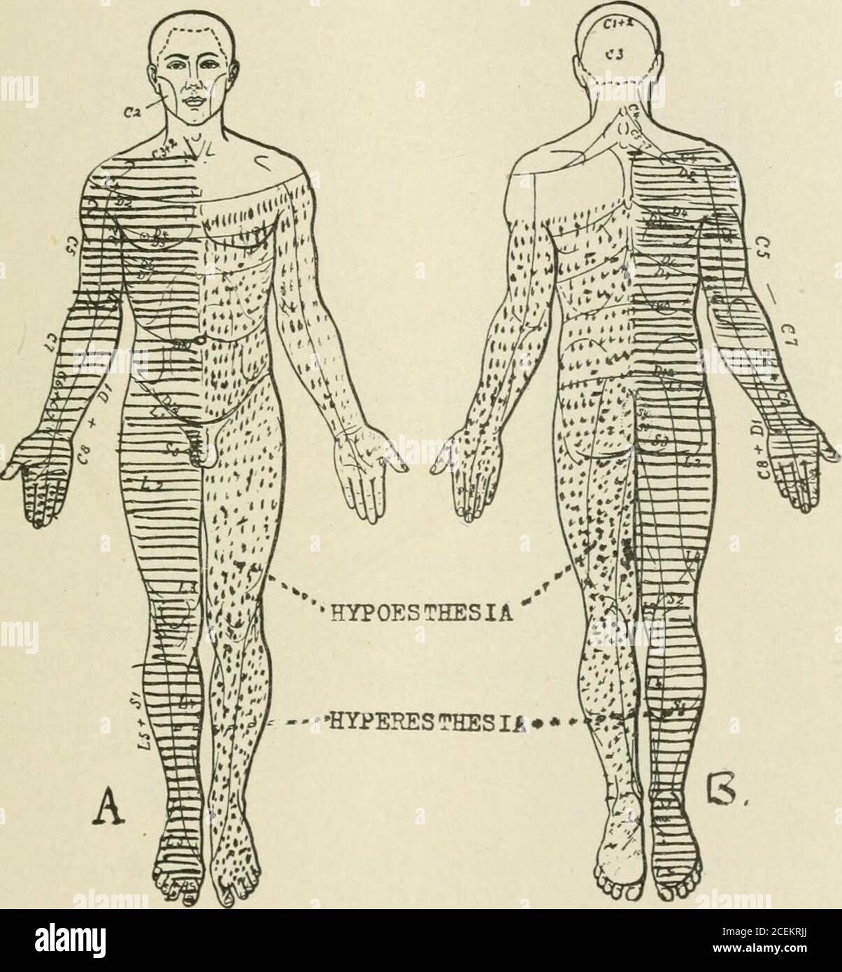 The Journal of nerveux and mental Disease. fy, gauchthand ARM normal. Aucun  mouvement du bras droit et de la main. Mouvement de la main gauche perdu,  certains mouvements des biceps gauche.tous
