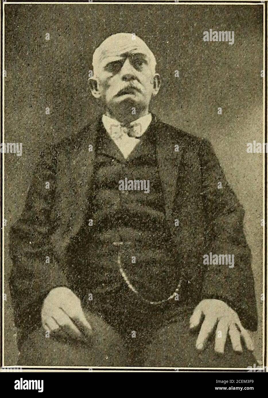 . Maladies du système nerveux : pour le généraliste et l'étudiant. Les deux tiers de la langue sont fournis par le téchorda tympani, le tiers postérieur par le neuvième nerf, le palais mou par l'abranque fiom Meckels ganglion. Le nerf facial peut être considéré comme un nerf amixé. Il a un ganglion (gen-iculate). Les fibres sensorielles sont : le grand pétrosal superficiel, le petit pétrosal superficiel et l'extersalpétrosal fournissant le plexus carotidien du sympathique. Le geniculateganglion envoie des fibres en cours d'exécution avec le septième nerf dans le Falloupiancanal, aussi des fibres anastomosing avec le cinquième A. Banque D'Images . Maladies du système nerveux : pour le généraliste et l'étudiant. Les deux tiers de la langue sont fournis par le téchorda tympani, le tiers postérieur par le neuvième nerf, le palais mou par l'abranque fiom Meckels ganglion. Le nerf facial peut être considéré comme un nerf amixé. Il a un ganglion (gen-iculate). Les fibres sensorielles sont : le grand pétrosal superficiel, le petit pétrosal superficiel et l'extersalpétrosal fournissant le plexus carotidien du sympathique. Le geniculateganglion envoie des fibres en cours d'exécution avec le septième nerf dans le Falloupiancanal, aussi des fibres anastomosing avec le cinquième A. Banque D'Images