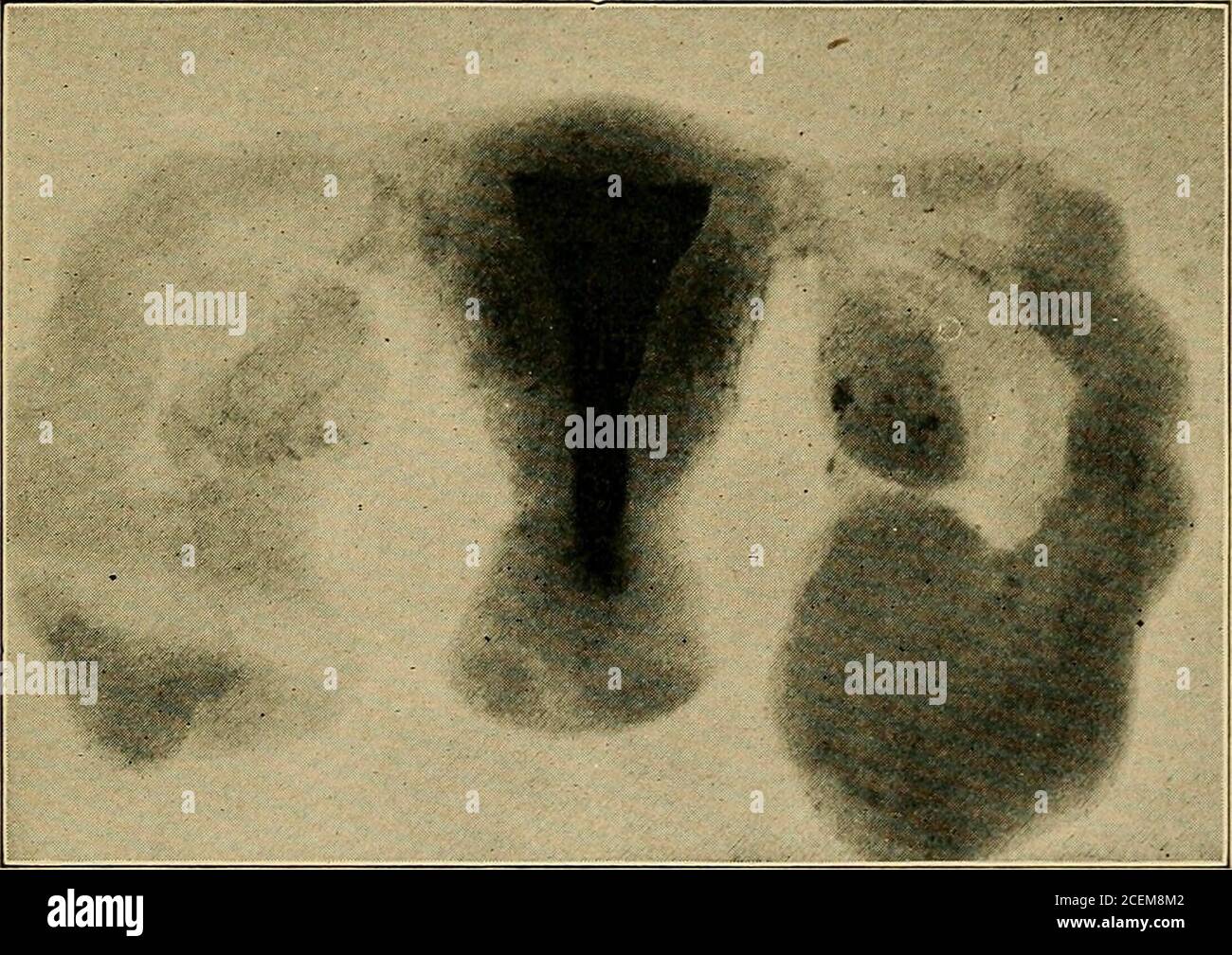 . Inflammation pelvienne chez les femmes. Figure 22.—UN utérus détendu après une ablation curetée. Il permet à la solution de baryum de percer dans les veines. (Sampson.) INFECTIONS PUERPERALES 69 genie cocci, agissant temporairement comme saprophytes ou comme des charognes, peut becomevirulent, et que les bactéries putréfactives ordinaires peuvent en présence du milieu de culture approprié (comme les caillots sanguins, les morceaux de placenta, les membranes, etc.) se multiplier si rapidement sur ce matériel mort qu'elles sont capables de produire une toxinémie grave. Pathologie.—les infections apparaissent d'abord dans le puerpérium sous la forme (i) d'infections locales, qui peuvent être primitives ou Banque D'Images