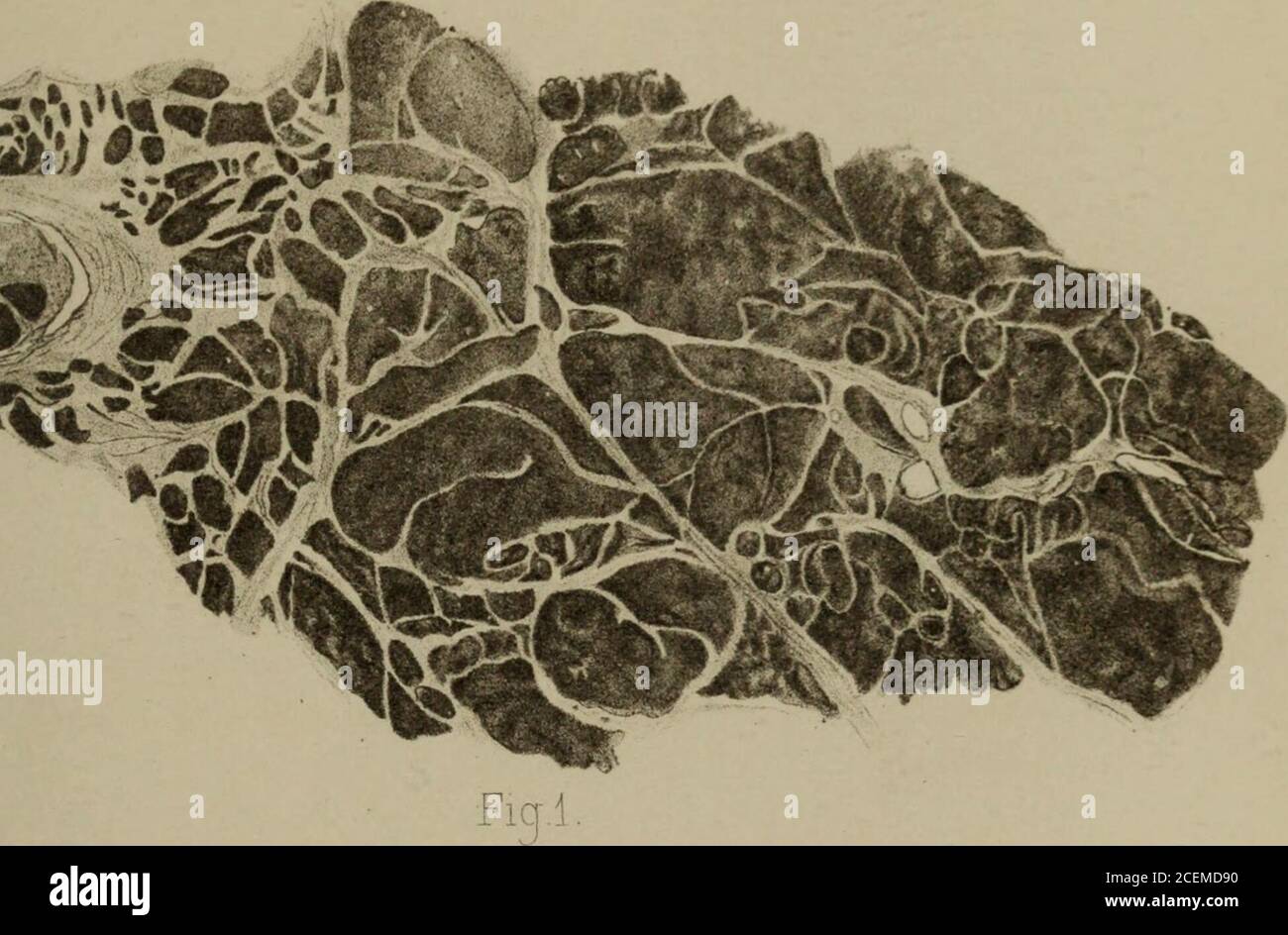 . Comme si elles étaient des points centraux, une indication peut-être de leur extension autour de la voie des vaisseaux sanguins. Un sang-cellules, qui peut être fait au centre de certains des tourbillons, semblent confirmer cela, et à indiquer que le vaisseau lui-même est à parois minces et probablement un capil-lary. DESCEIPTION DE LA PLAQUE I. illustration de M. Braileys cas de tumeur en croissance de la gaine durale du nerf optique. Dessins de PROM par M. M. H.Lapidge. Figure 1.—Section montrant son origine de l'aspect périphérique extrême du thesheath, avec lequel ses septa fibreux (représentaient la hauteur Banque D'Images