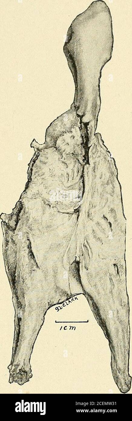 . Maladies des enfants. Phaticus mort thymique. Homme, âge de la pouvirtine années; asthme de longue durée; autrement en bonne santé. Recevoir une dose d'antitoxine; mort en quelques minutes. Hyperplasie notable des nœuds de manylymph. Le thymus se compose de deux lobes latéraux ressemblant à la langue qui s'étendent du cœur du clownwardover au diaphragme; pas de lobe médian; poids 17 grammes. Marge supérieure du behindsternum supérieure à 2 cm. Sous l'encoche. Aucune trace de compression trachéale. Le tiers supérieur de chaque lobe présente une capsule ridée, une infiltration de graisse et un retrait, ce qui démontre une régression. L'absence d'isthme ou de masse au point de junc Banque D'Images