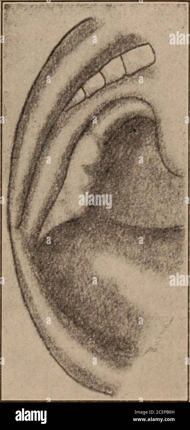 Journal of ophthalmology, otology and laryngologie. fig. V. dans les  amygdales profondément submergées, on utilise seule la dissection par  ciseaux, le ton-sillotome qui complète l'opération. L'emballage utilisé est  du coton légèrement