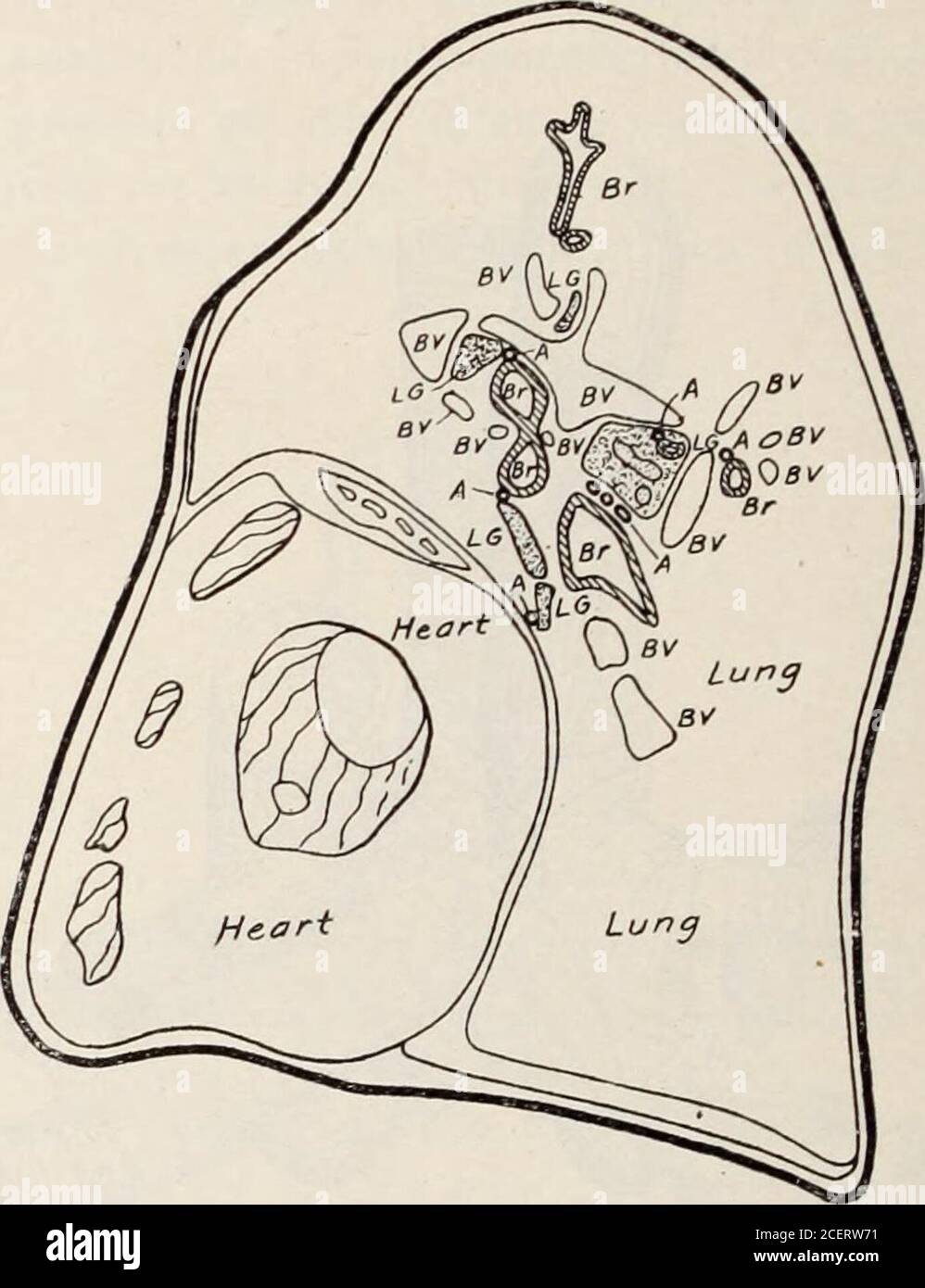 . Transactions de l'American Climatological and Clinical Association. Fin. 4.—Schéma de la vue ventrale de la Fig. 2. Montre une hypertrophie considérable des glandes lymphoïdes, et une artère bronchique droite anormale, étant ici une branche de l'artère bronchique gauche. Ses relations avec les glandes lymphatiques agrandies sont à noter. cadaver, dont l'histoire était inconnue, Mais l'apparition des poumons a montré au-delà de l'ombre d'un doute que la cause de la mort était une pneumonie lobar aiguë, les lobes supérieurs et inférieurs du poumon droit étant au stade de l'hépatite grise 344 W. F. R. PHILLIPS, et le lobe moyen marqué Banque D'Images