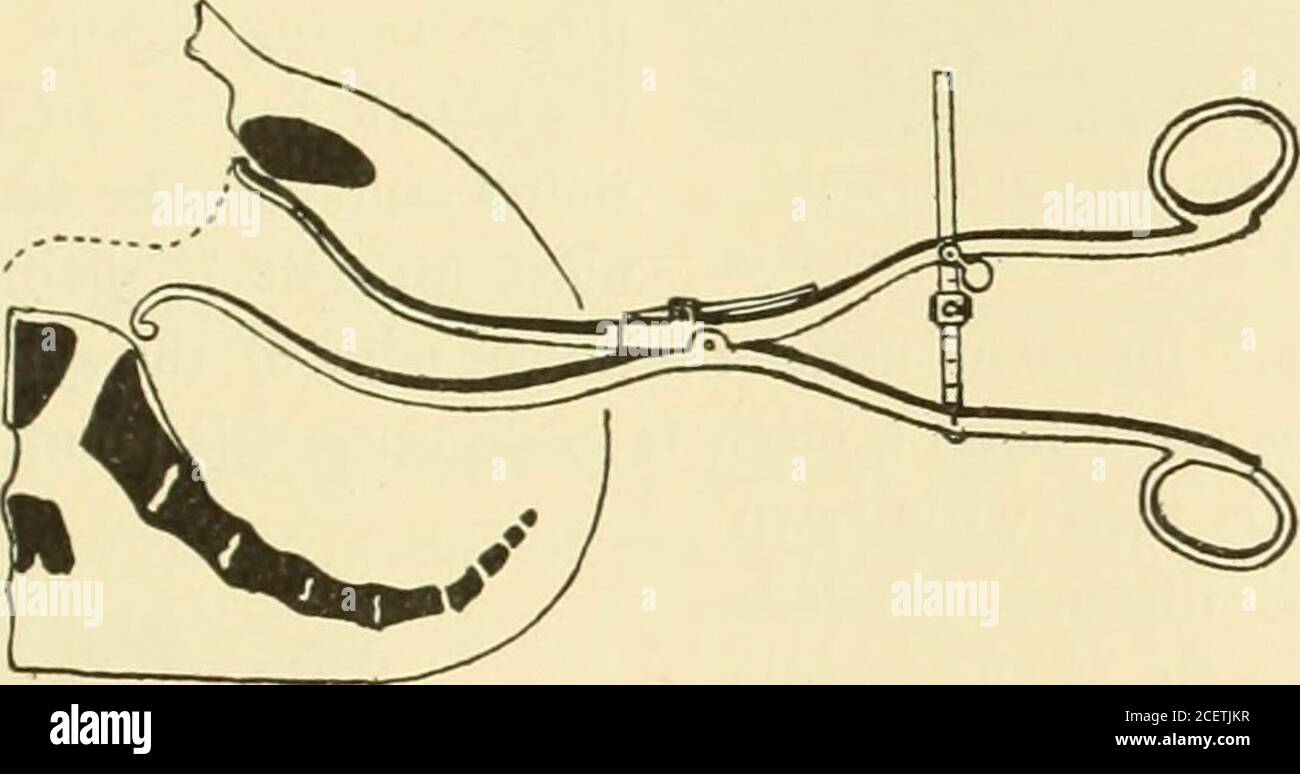 . Un livre de texte américain d'obstétrique. Pour les praticiens et les étudiants. Est fermement fixé; le pelvimètre ayant été soplacé que l'indicateur est tourné vers l'examinateur, la mesure est donc facilement lisible dès que le pelvimètre est en position correcte. ITIS en moyenne, chez les femmes bien construites, 20J centimètres. Les meilleurs moyens pour déterminer la longueur du diamètreantéro-postérieur de l'entrée pelvienne sont la mesure prise du bord inférieur de la thesymphyse pubis au promontoire du sacrum, le diamètre conjugatéen diagonale, et la distance entre la surface externe supérieure Banque D'Images