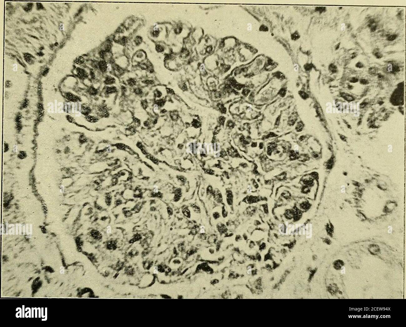 . Rapport médical et chirurgical. I. (d) Schroeder. Agrandissement élevé du tube du rein montrant une régularité ir avec occlusion de la lumière. Néphrite interstitielle chronique. TEST DE PHÉNOSULFO-PHTHALEIN DANS L'ÉLIMINATION DES REINS 83. 1^ ; et lt ; N° I. (E) Schroeder. Grossissement élevé de la fibrose des reins avec contraction. Banque D'Images