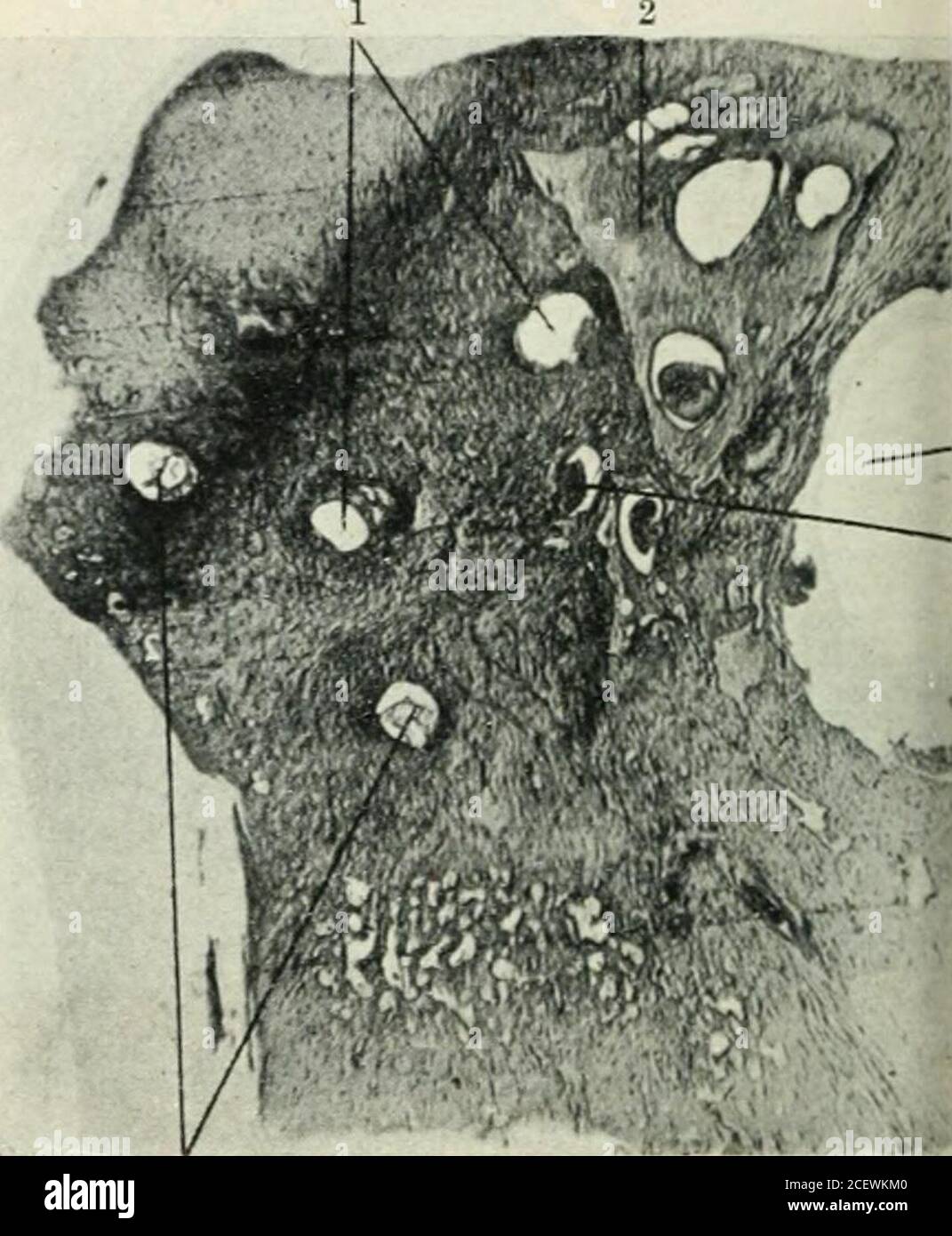 . Le Journal de la laryngologie et de l'otologie. FiO. Y.—oreille gauche malade. Non (Section colorée par la méthode de l'hjematoxyline-fer.) 1. FhcibI Nerve Well Bared. En dessous et à droite, le nerf de la lecochlear n'est pas taché et présente une dégénérescence.:i. Mlili.hij ?i. Iluct cochléaire dilaté de l'antenne centrale.I. Tensor tynii)ani.5. Tymi) cavité.C. Canal carotidien. 7. L'antenne basale de la cochlée remplace l'os de tiew bv. 8. .Jugular Isilli. S&lt;. Aijueduct de cfichlea. Figure 7a.—oreille gauche malade. N° 520. 1. Canal externe. Aditus presque oblitéré par épaississement du tissu conjonctif des muqueuses i. 3. Méatus externe. 4 Banque D'Images